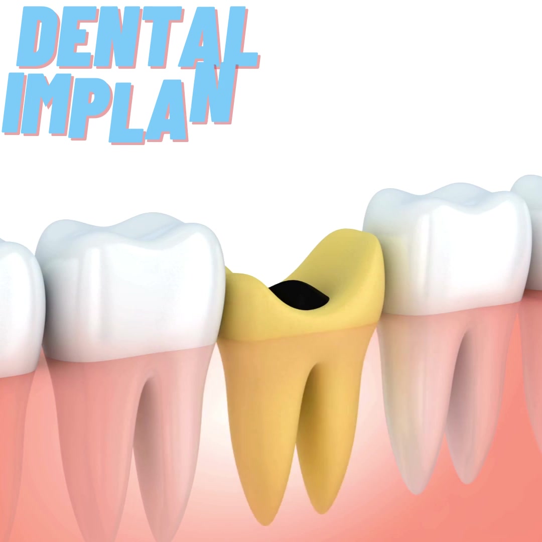 Tooth Advisors Facebook ad: Free X-rays & Dental Implant Consultation