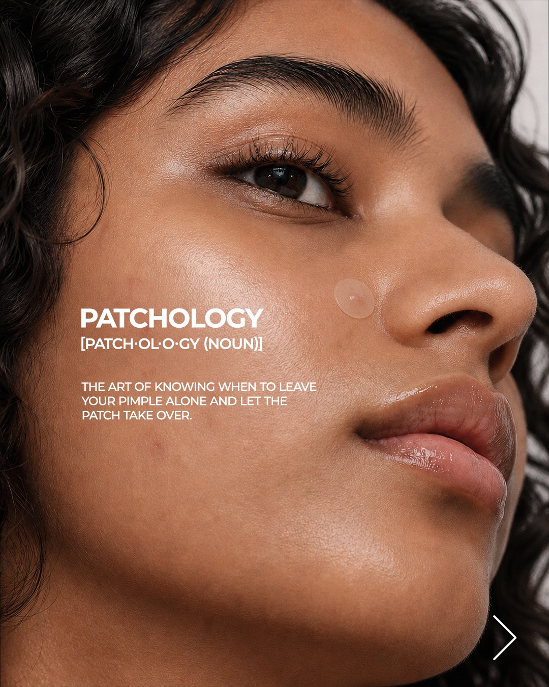AcneStar Facebook ad: All breakouts are annoying, but not every pimple…
