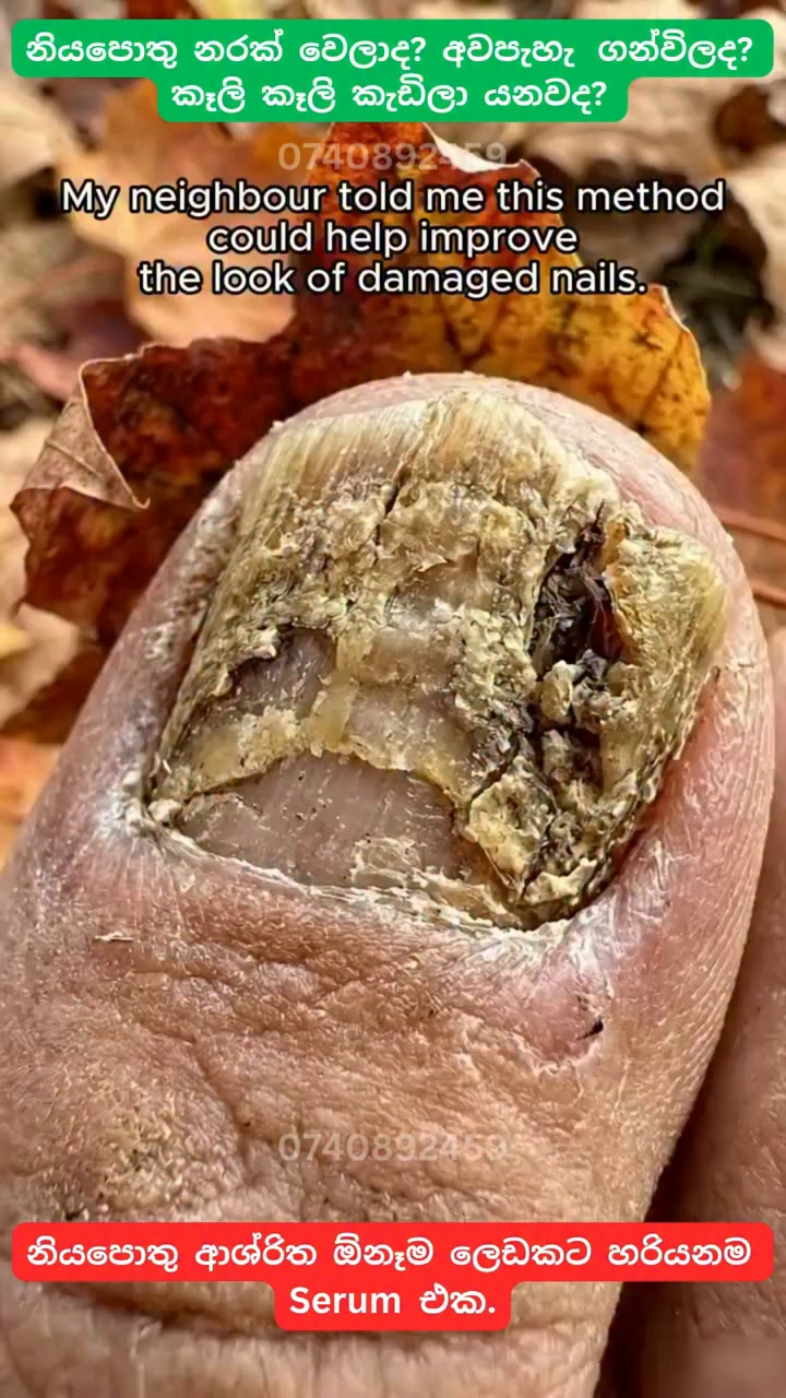 Nail Fungal Ointment Facebook ad: Rs.1990 | මිලදී ගැනීමට අවශ්යනම් පමණක් පෝරමය පුරවන්න.