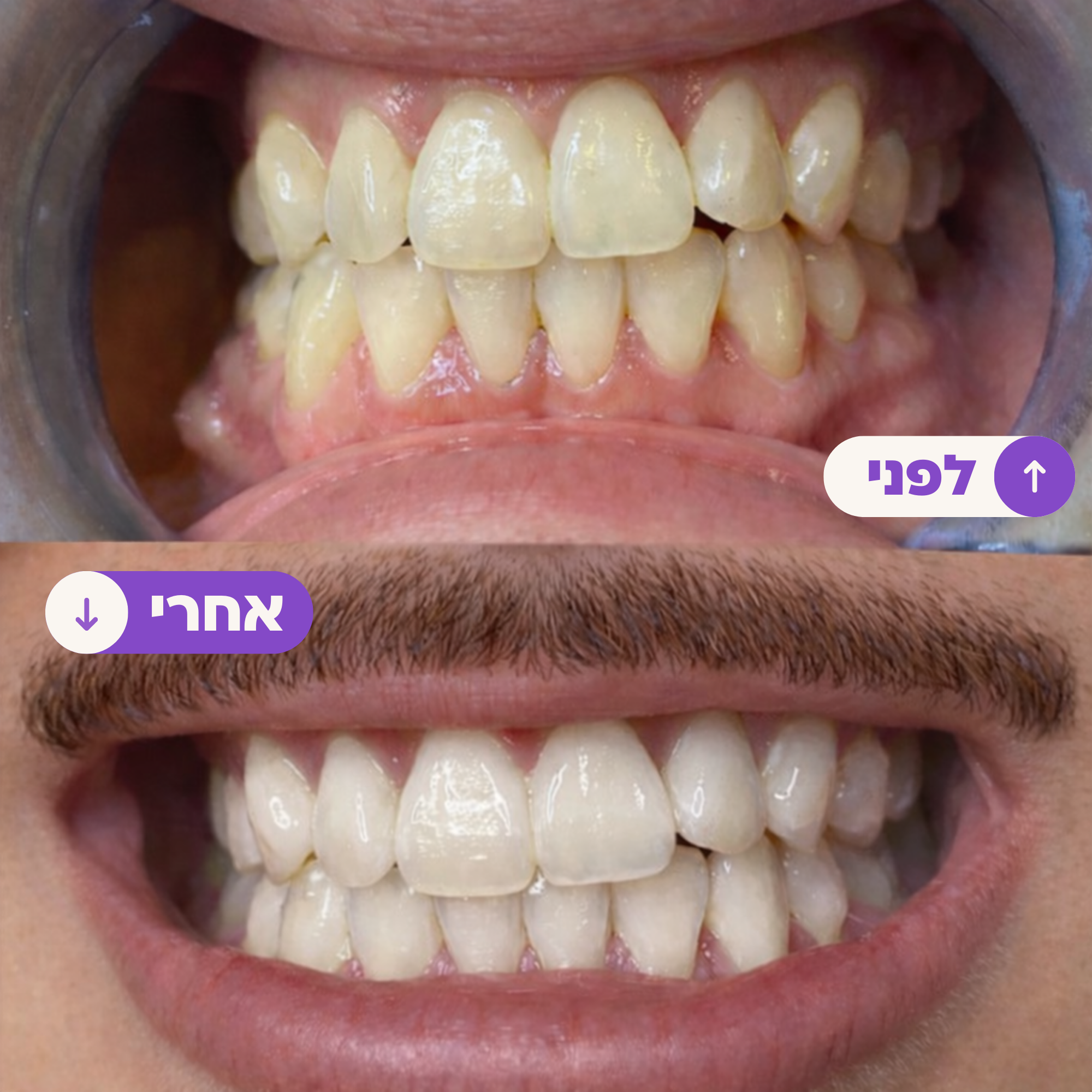 המלצות על הלבנת שיניים Facebook ad: ניסיתם רצועות הלבנה בעבר ושנאתם את הרגישות? זה שונה