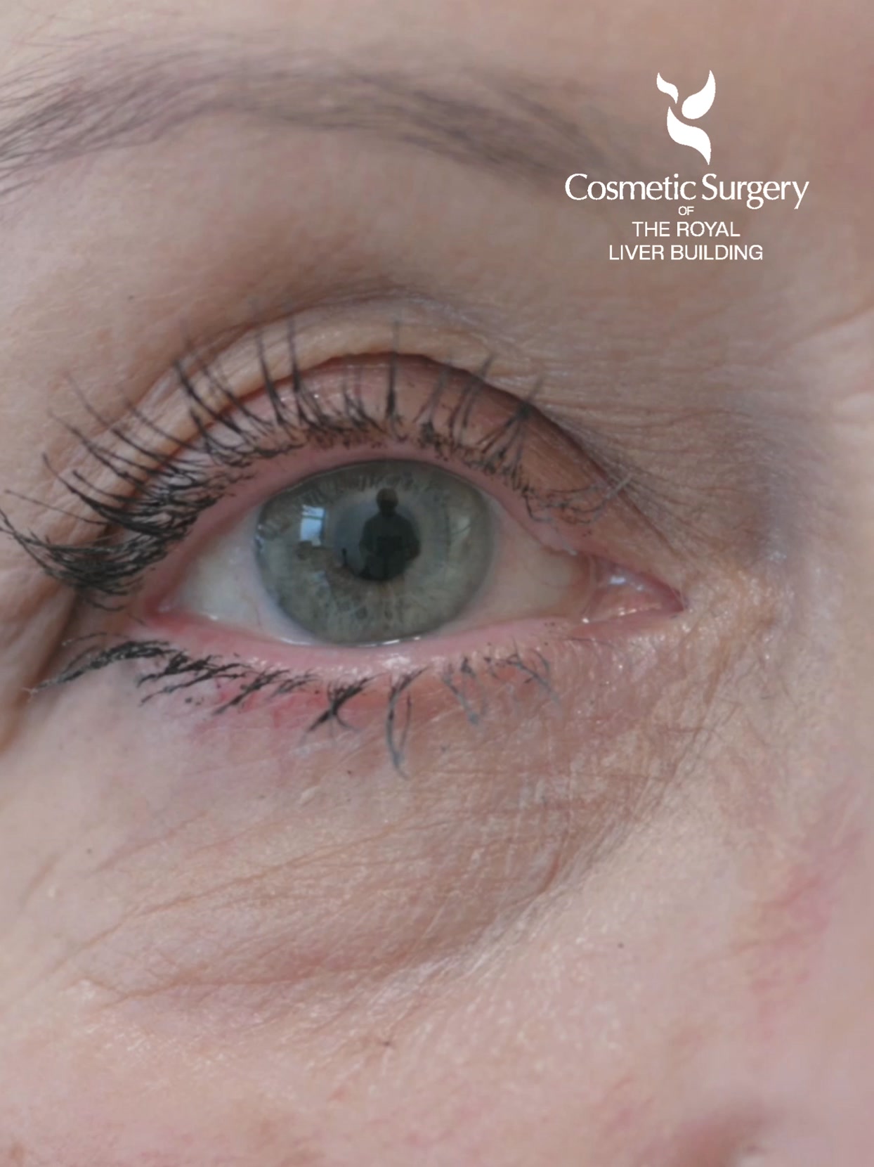 Aesthetics Of The Royal Liver Building Facebook ad: £500 Off | Upper Eyelid Blepharoplasty | From £2500