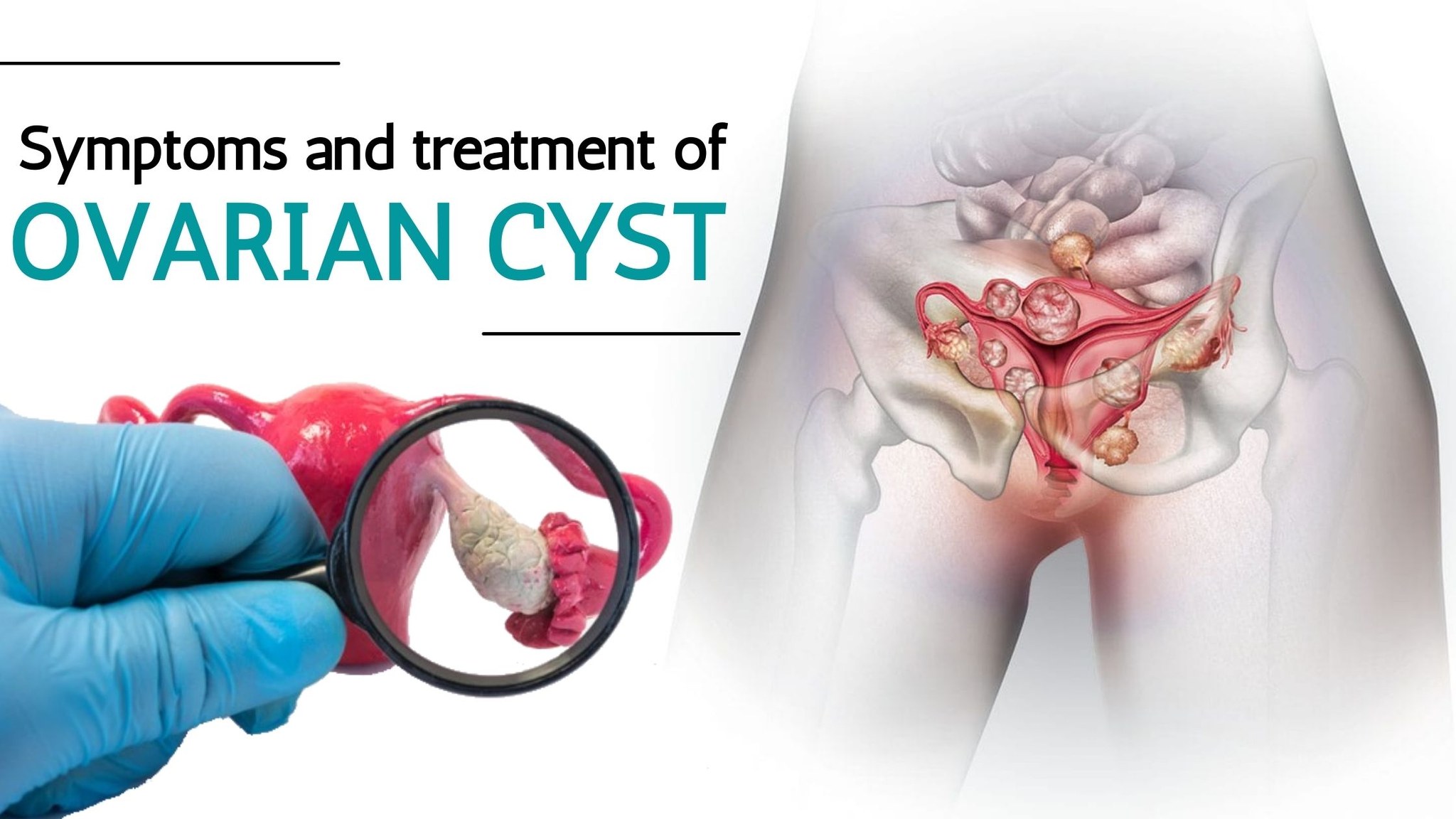 Health Solutions in Nairobi, Kenya Facebook ad: OVARIAN CYST TREATMENT
