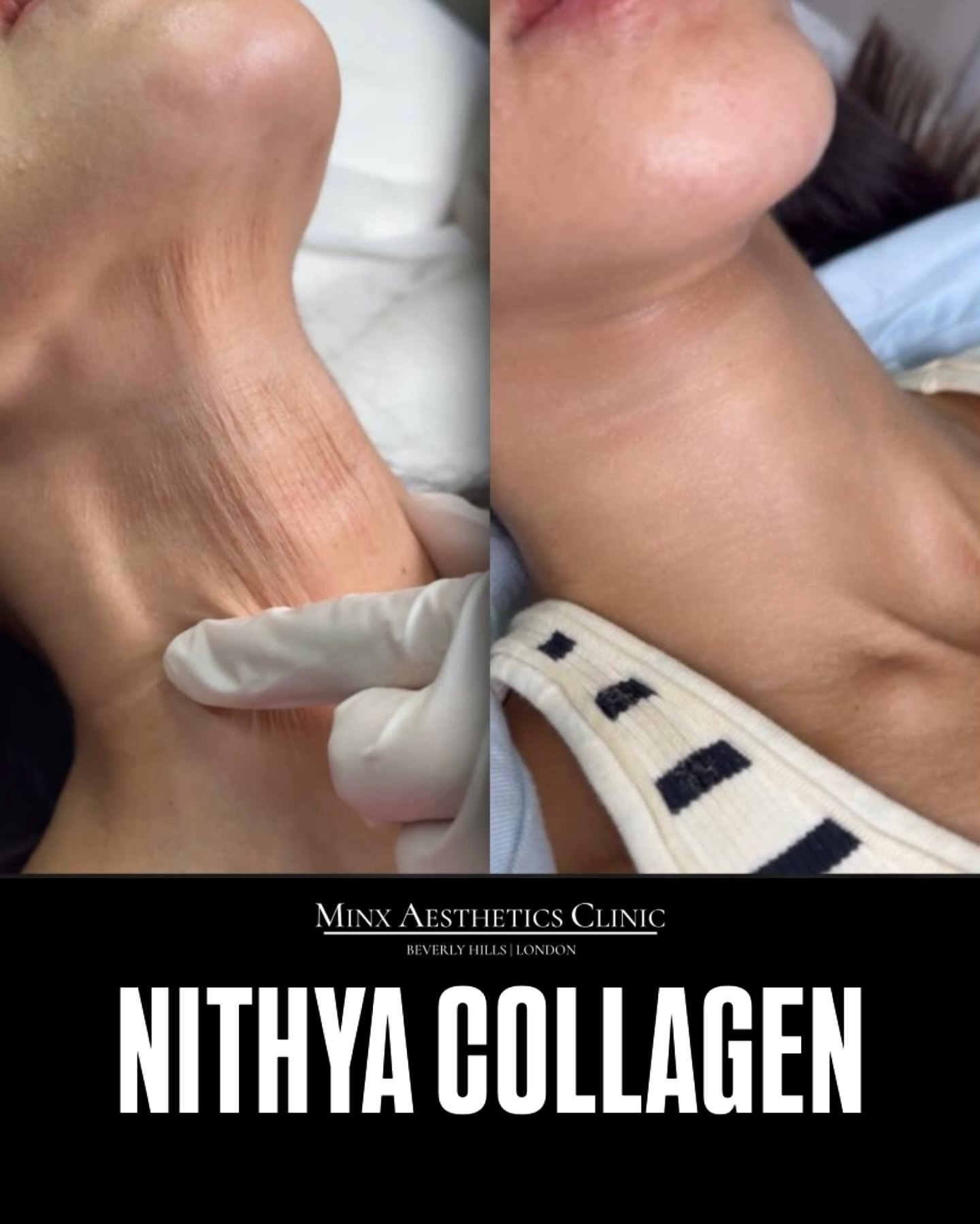 Minxaesthetics Facebook ad: Nithya Collagen is a cosmetic treatment designed to…