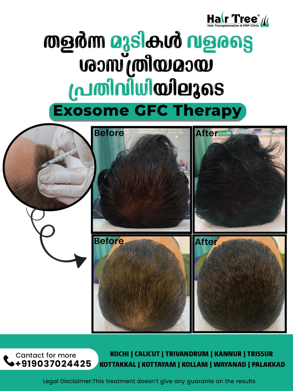 HairTree Hair Transplantation & PRP Clinic Facebook ad: HairTree (@hairtree_hairtransplantclinic) • Instagram…