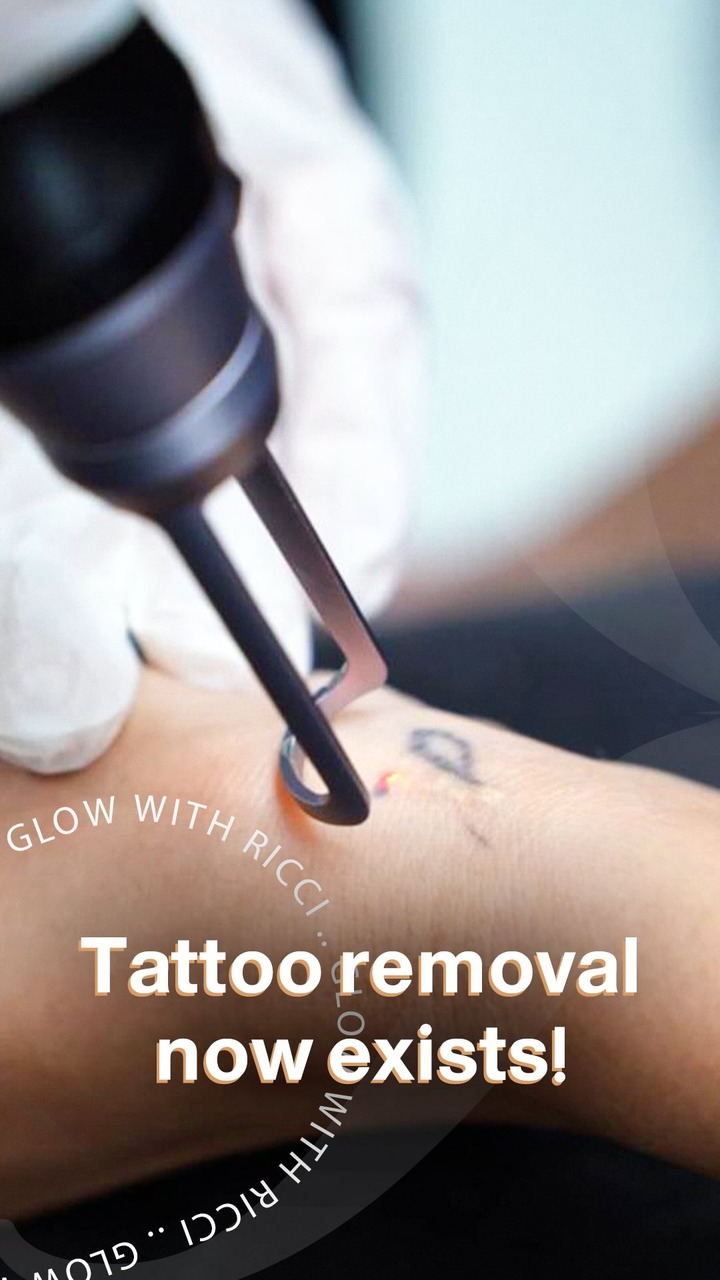 Ricci Aesthetic Clinics Facebook ad: Tattoo removal is no longer impossible!
