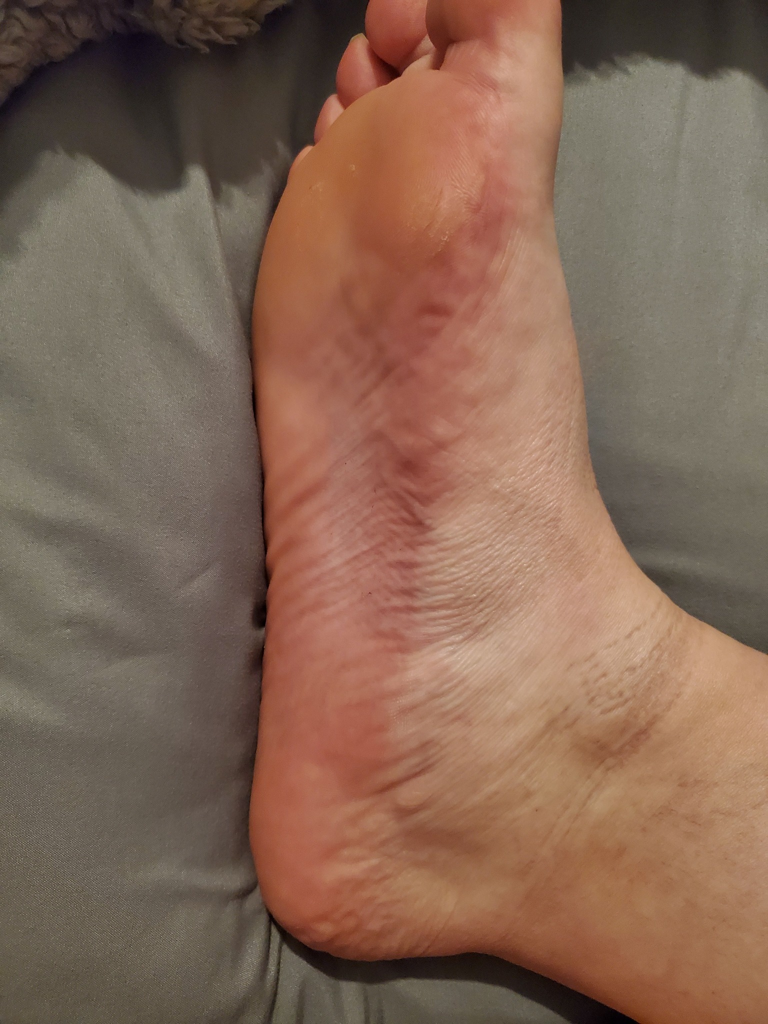 Laura Bennet Facebook ad: Read If You Have Plantar Fasciitis