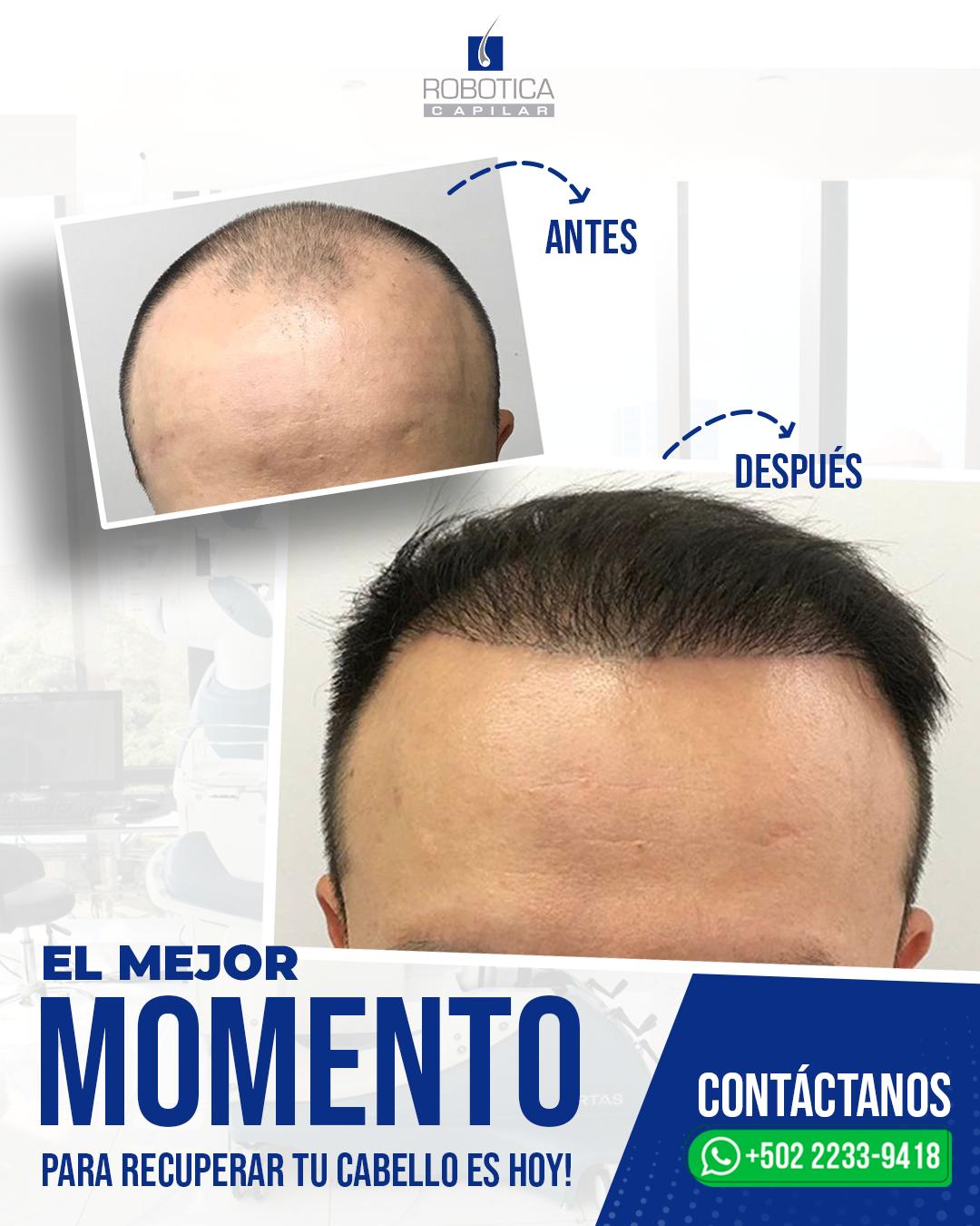 Robotica Capilar · Trasplante Capilar · Hair Restoration · Rejuvenecimiento Facebook ad