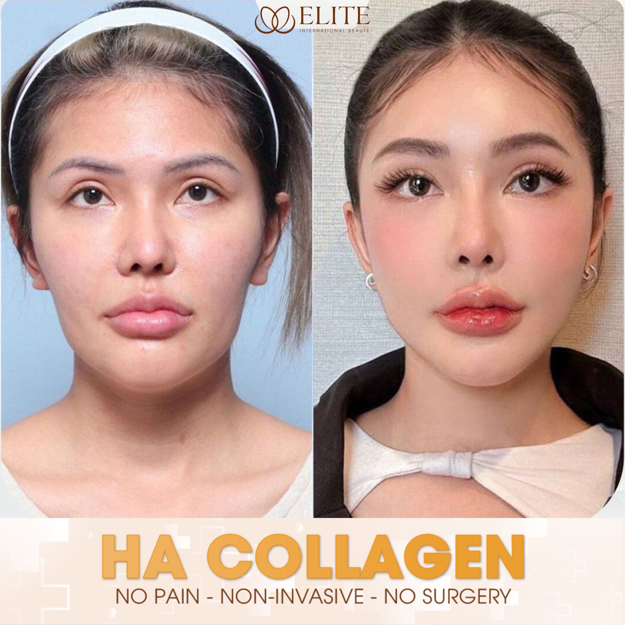 ELITE International Aesthetic Institute - Laguna Branch Facebook ad