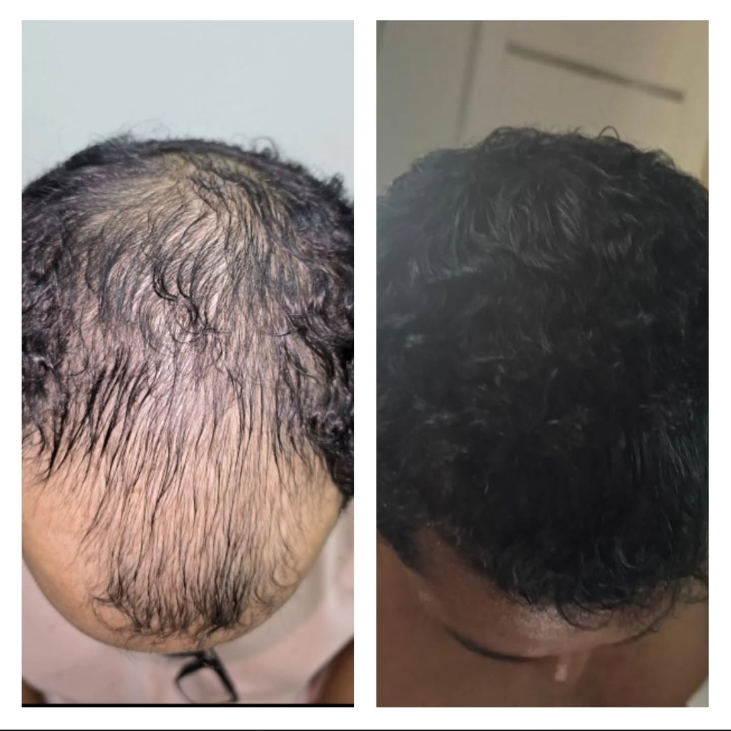 Capillary Transplante Capilar Facebook ad: Aquele antes e depois de menos de 9…