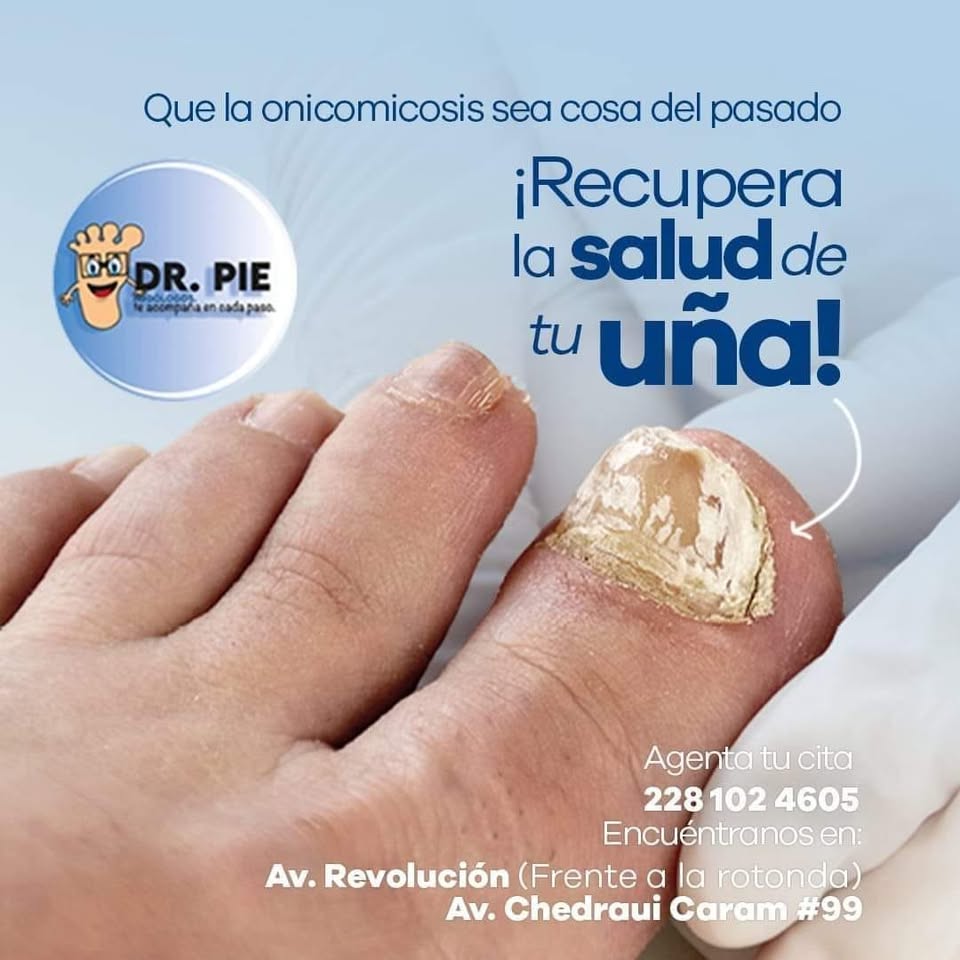 Dr. Pie Podólogos Xalapa Facebook ad: HONGOS EN LAS UÑAS