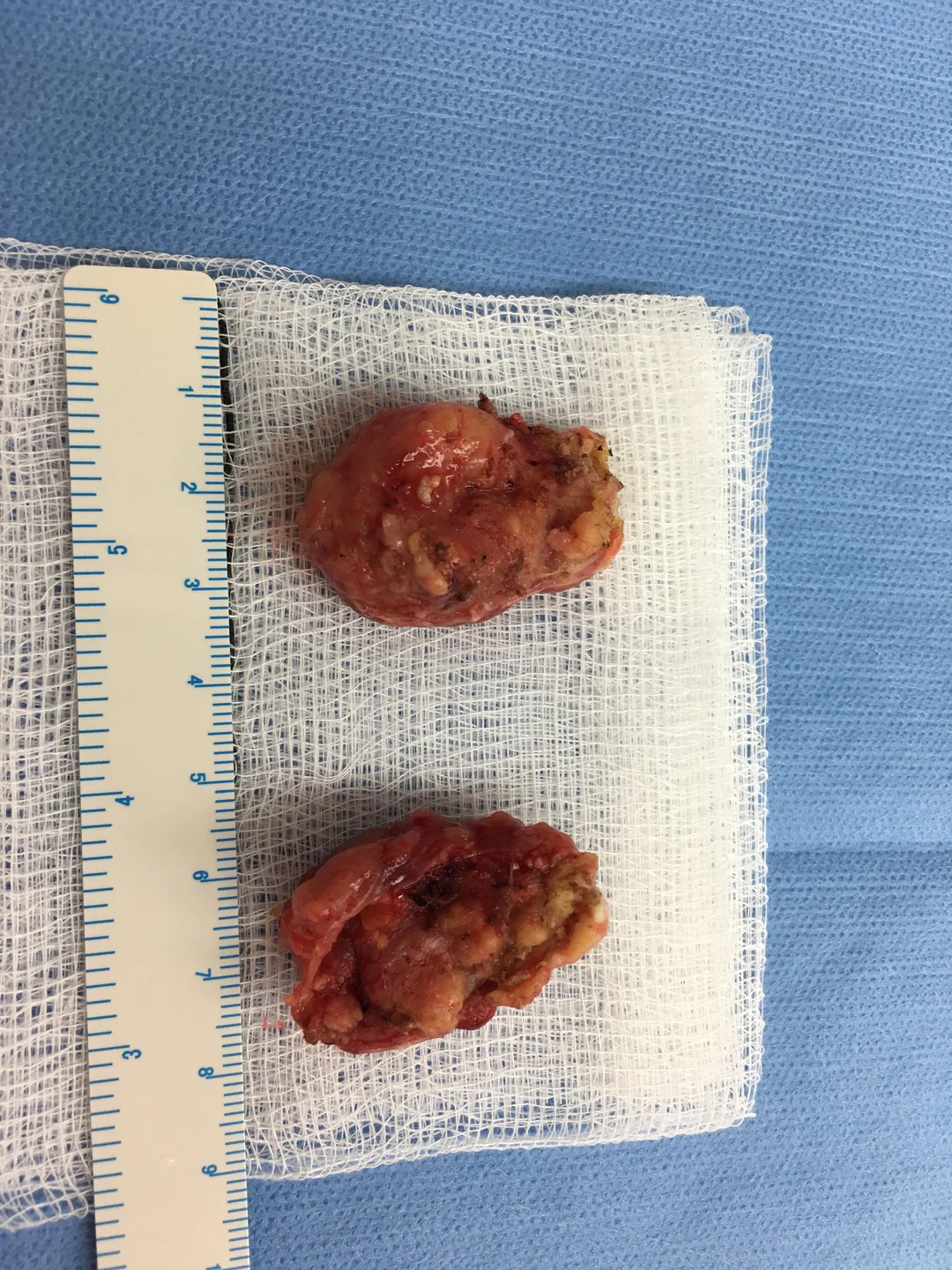 Nuviway Facebook ad: Should you get tonsillectomy?