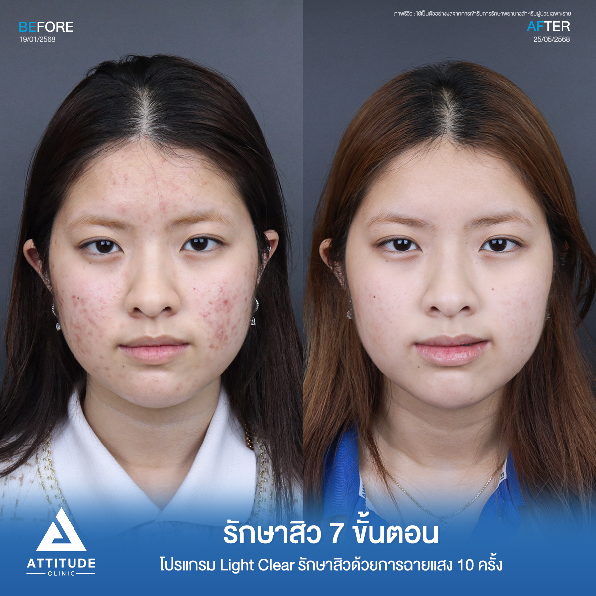 Attitude Clinic เชียงใหม่ Facebook ad: เพื่อนทักเรื่องสิวบ่อยมาก! ไปโรงเรียนแบบหน้าสดไม่ได้จริง ๆ