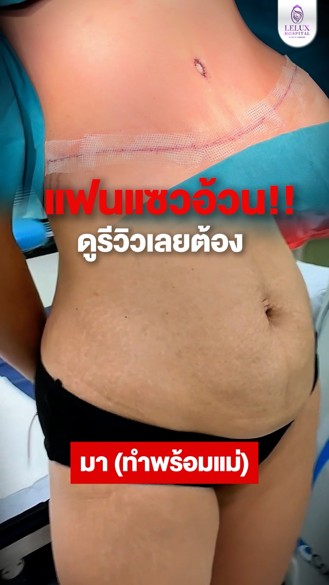 โรงพยาบาล เลอลักษณ์ ศัลยกรรมตกแต่ง Lelux Plastic Surgery Hospital Facebook ad: ท้องย้วย ดูรีวิว ตัดสินใจมาทำ ชวนแม่มาทำพร้อมกัน…