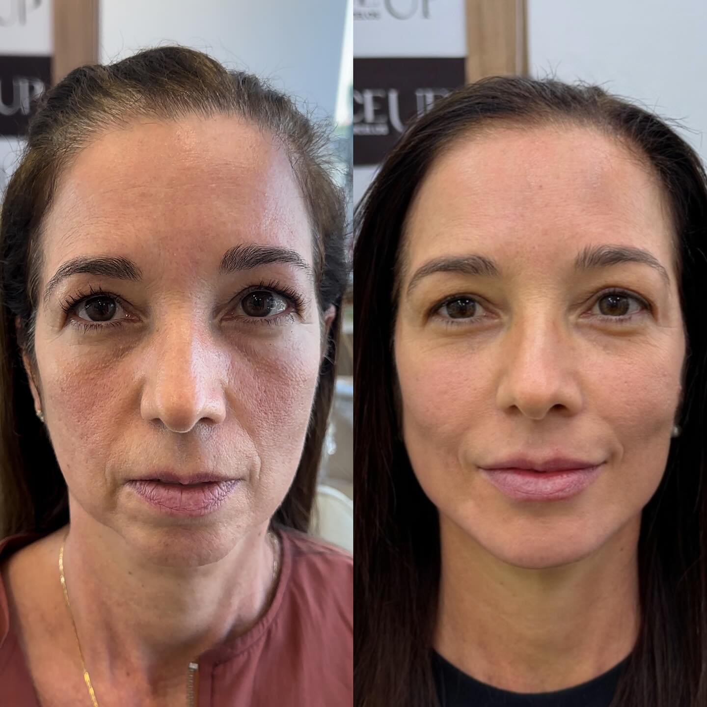 Dra.Fernanda Porto Facebook ad: Derretimento facial? Sei que incomoda você também.