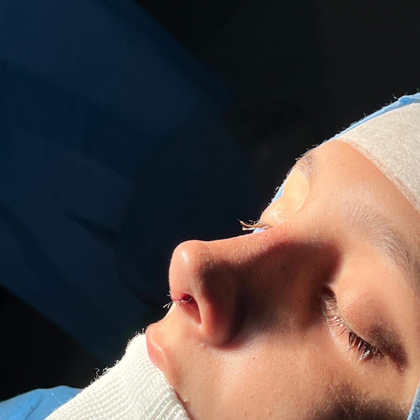 Rinoplastia Florianópolis - Dr. Guilherme Pilla Caminha Facebook ad: Aumentar sua beleza, elevar sua autoestima e crescer…