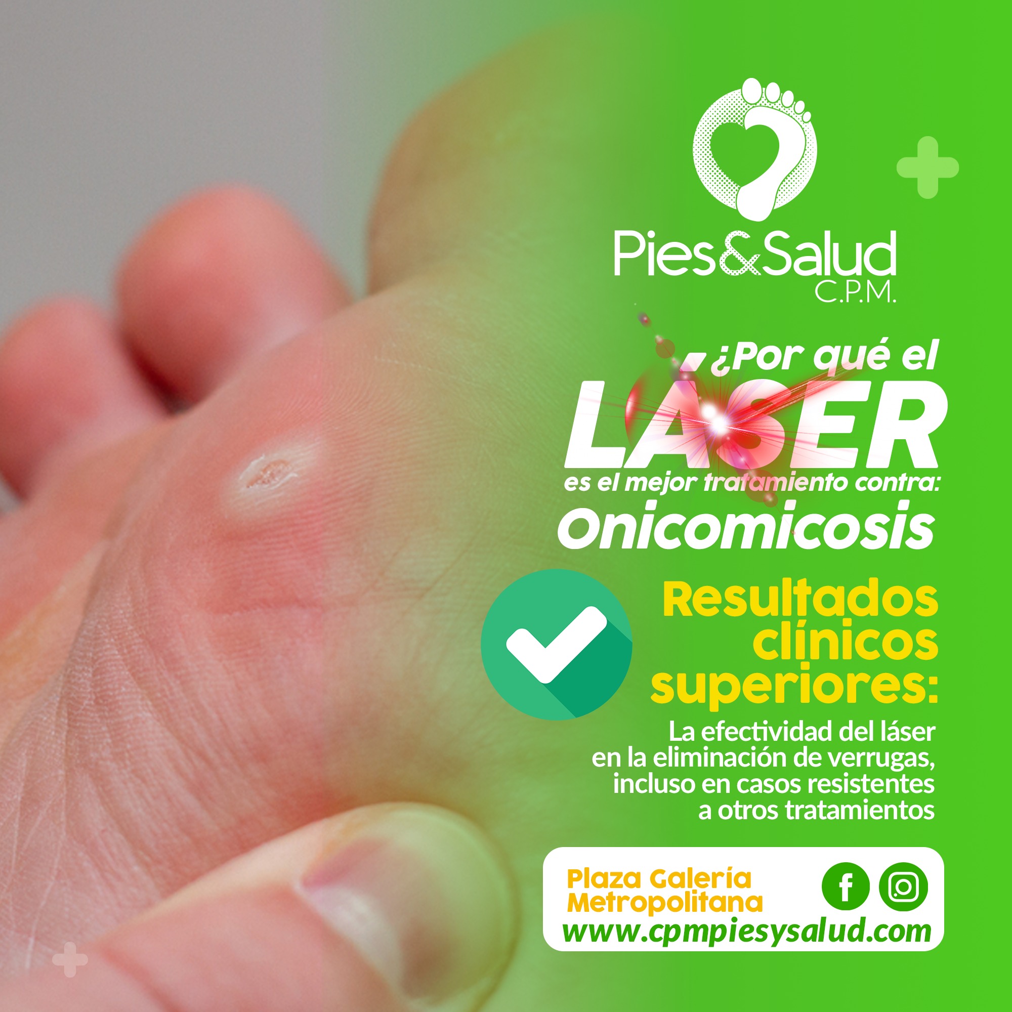 Podólogos Pies&Salud Moroleon Facebook ad: Elimina la onicomicosis con el poder del láser