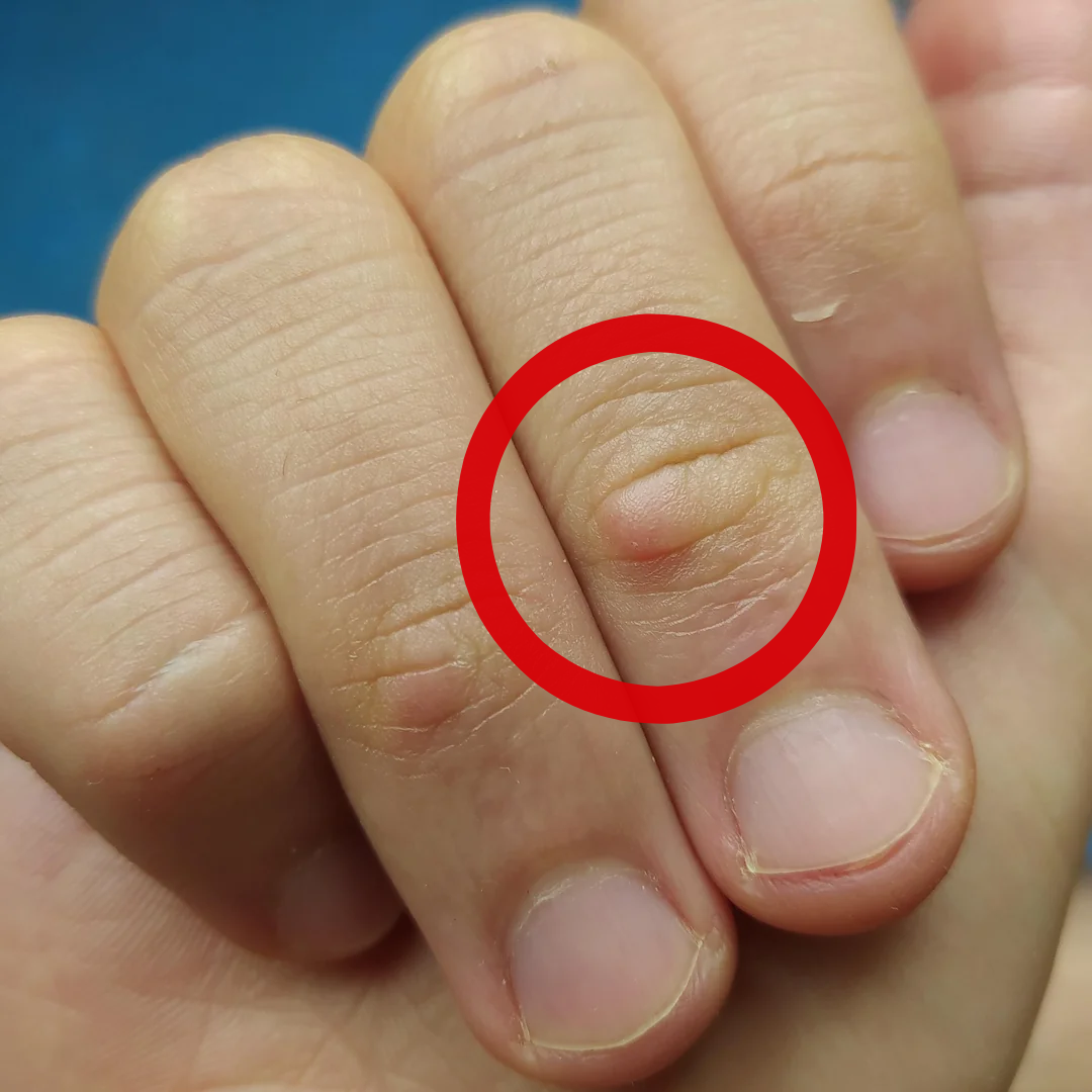 Dr. Thomas Abbott Facebook ad: Read This If You Have Bumps On Your Fingers