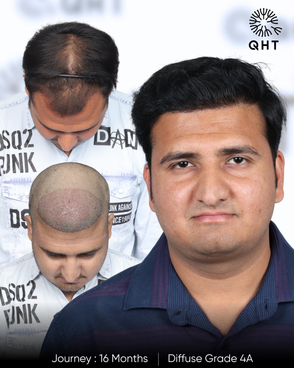 QHT Hyderabad- Best Hair Transplant Clinic Facebook ad