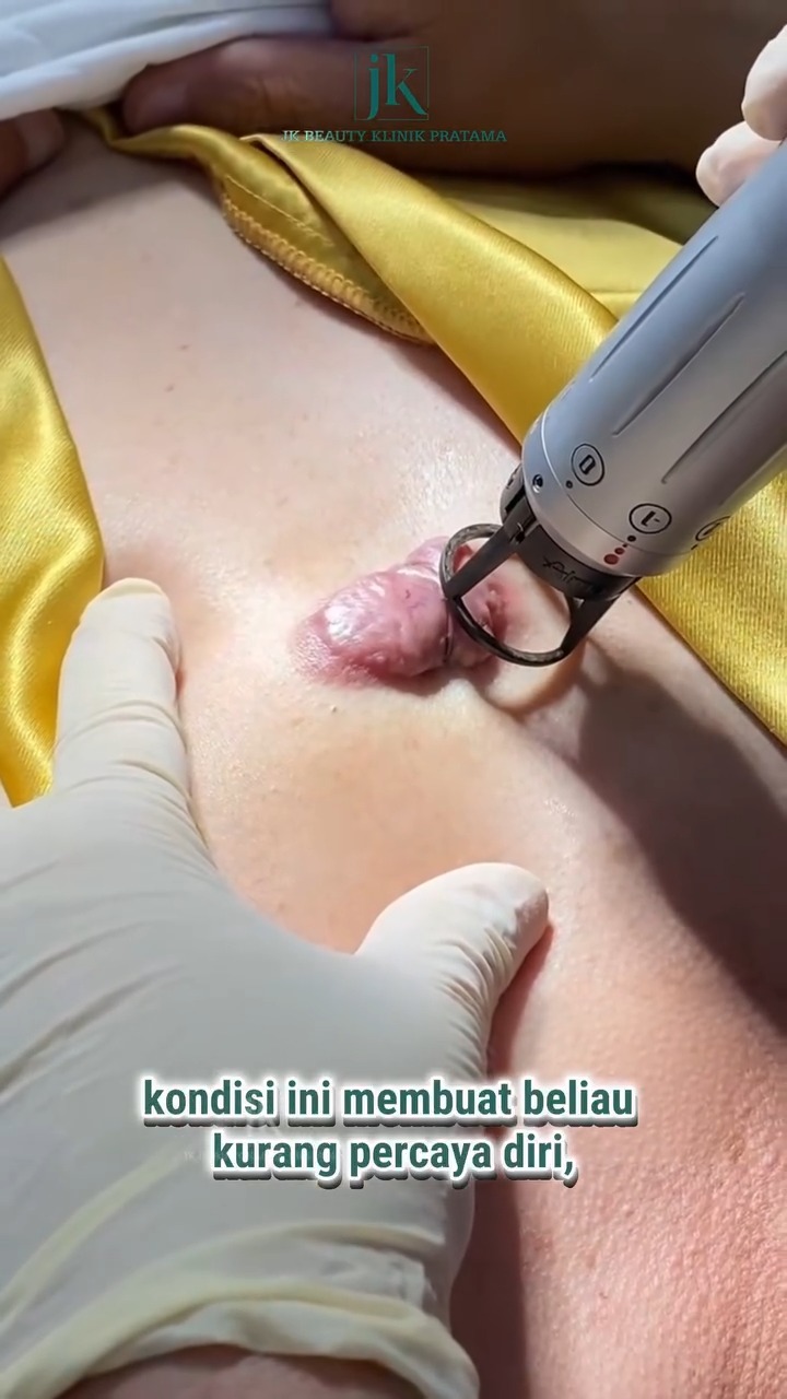 Scarmax - JK Beauty Klinik Pratama Facebook ad: Keloid makin menebal dan mengganggu rasa percaya diri?