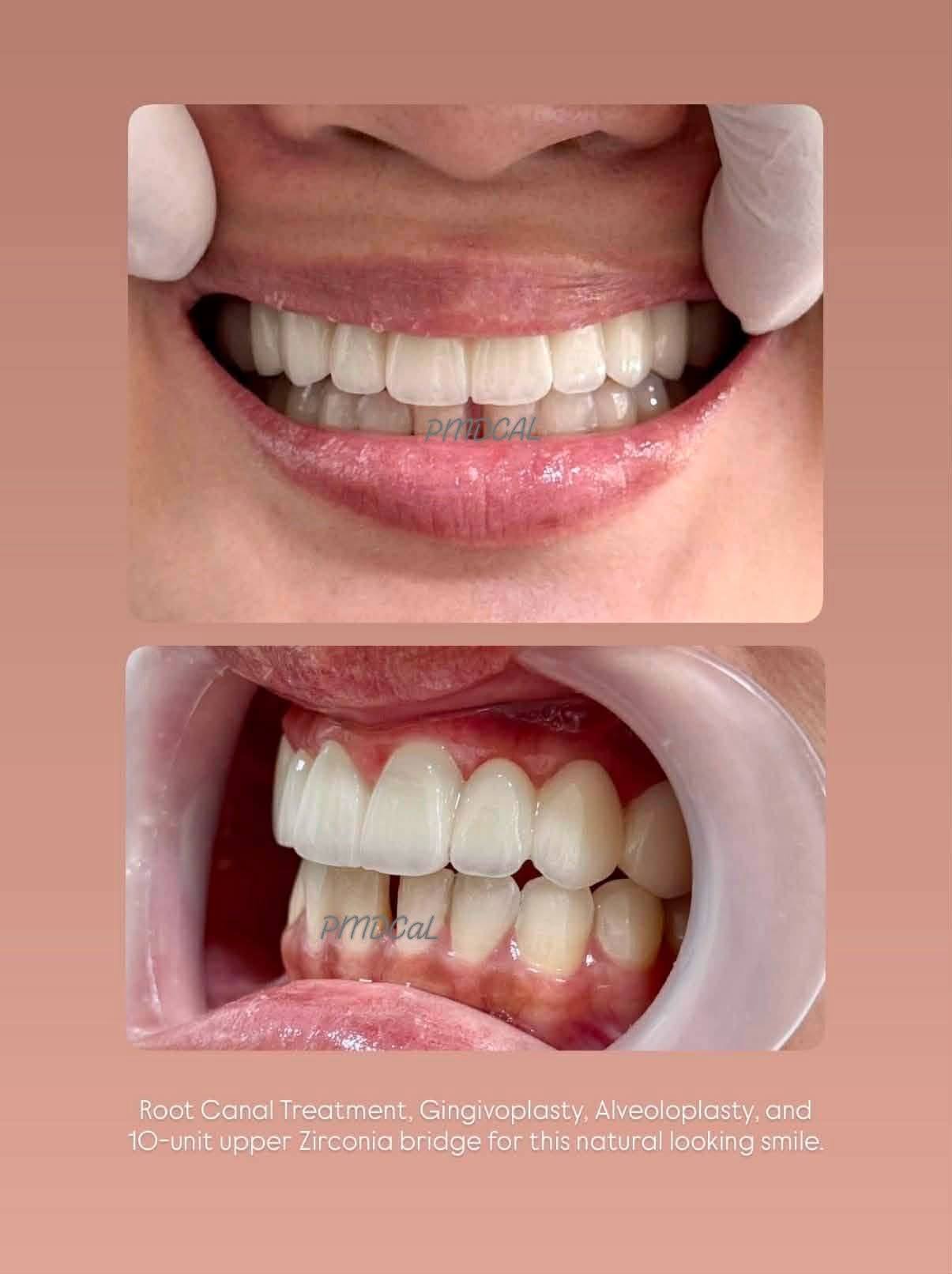 PMDCaL Cavite Facebook ad: Zirconia upper