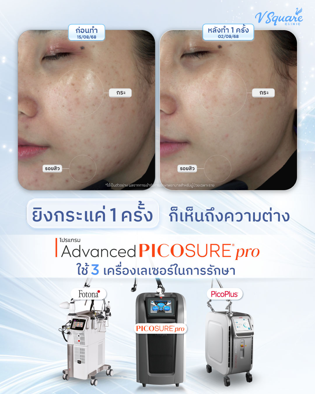 V Square Pico laser ฝ้า กระ หลุมสิว หน้าใส Facebook ad