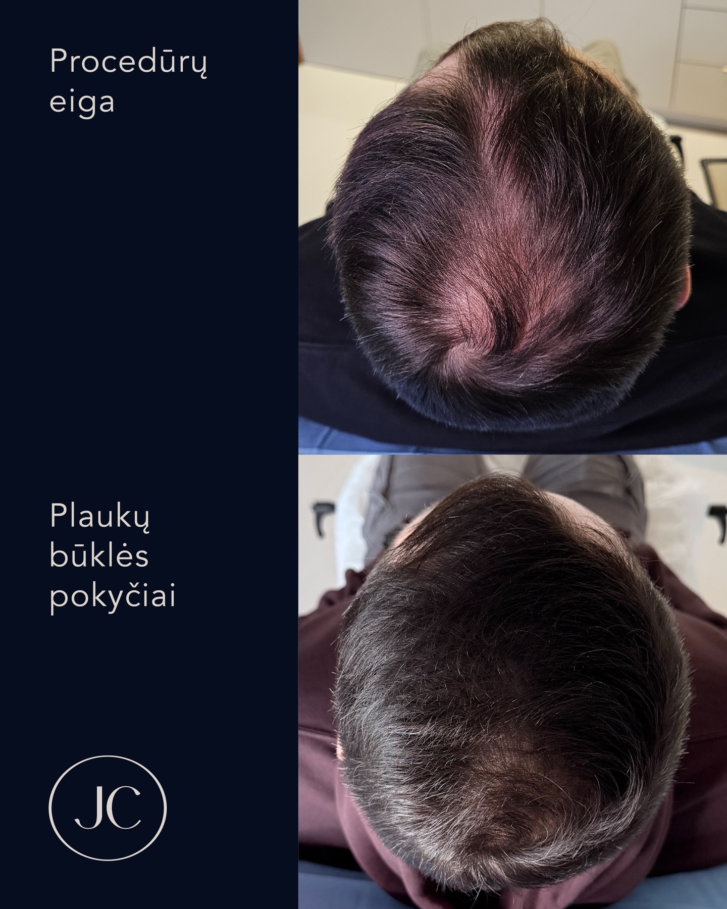 Jankus klinika - skausmo gydymo centras Facebook ad: Atliktos plaukų svogūnėlių proliferaciją skatinančios…