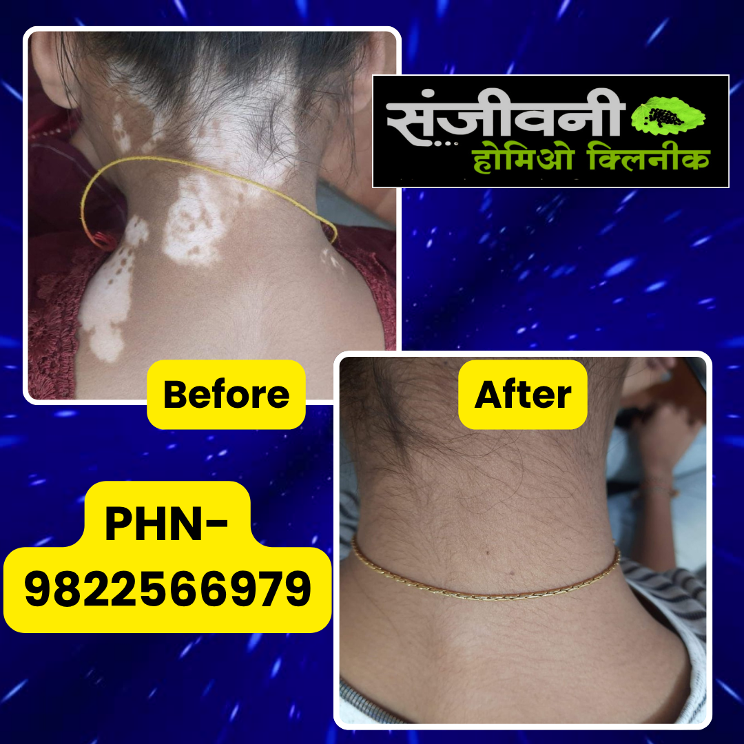 Sanjeevani Homoeo Clinic Facebook ad: पांढरे डाग (Leucoderma), योग्य उपचाराने सुधारणा शक्य आहे