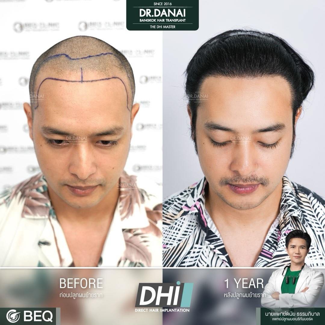 Dr. Danai Bangkok Hair Transplant ปลูกผมถาวร Facebook ad
