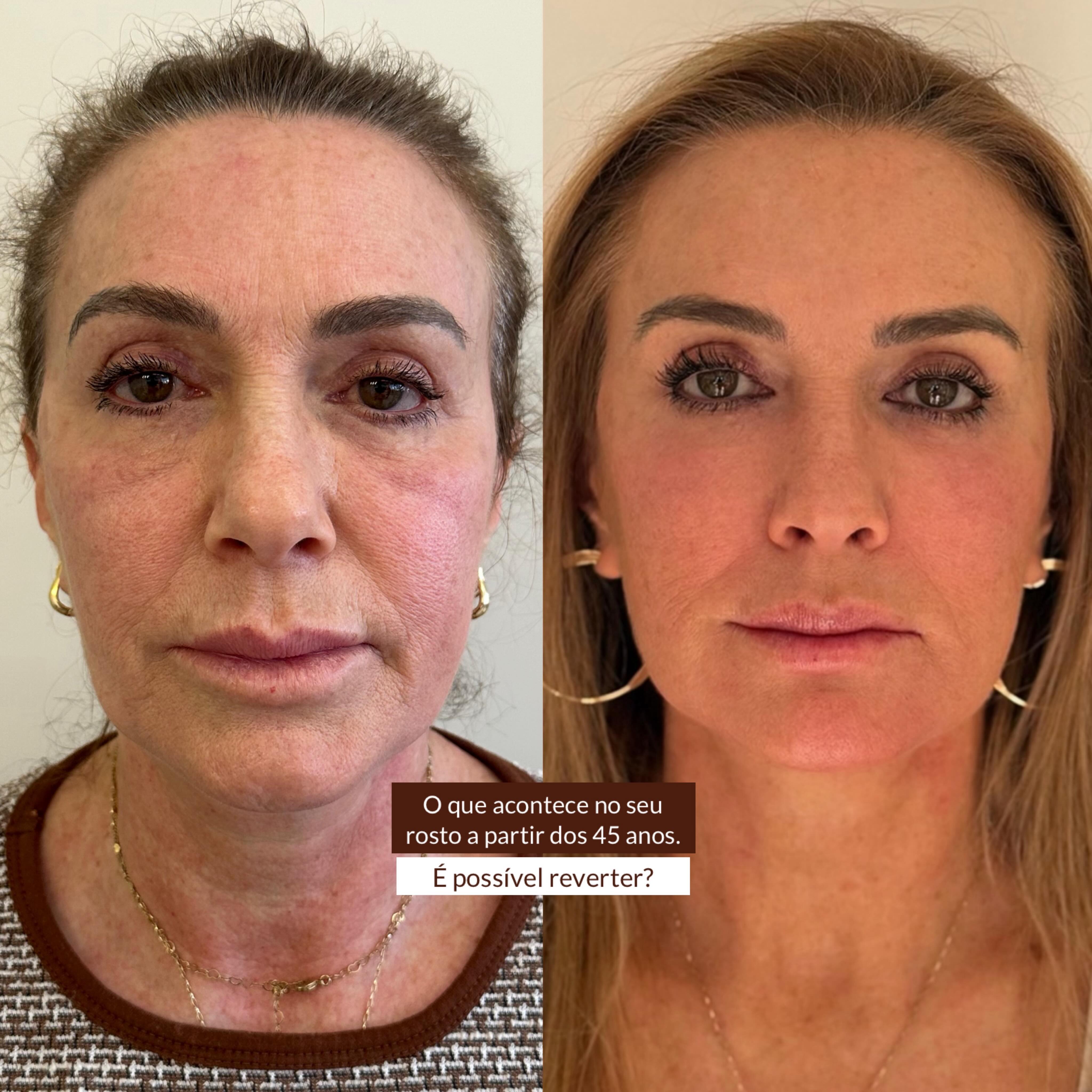 Cirurgiã-Dentista Verônica G. Rosseto Facebook ad: A partir dos 45 o rosto começa a…