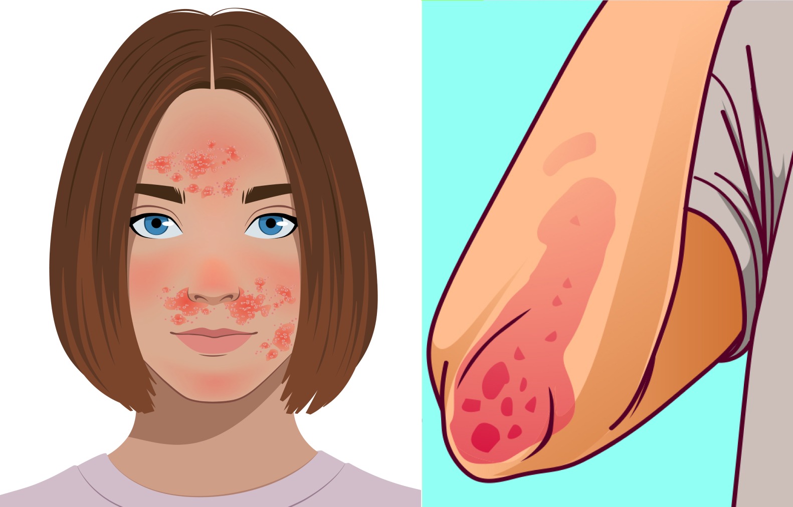Eczema & Psoriasis Blog Facebook ad
