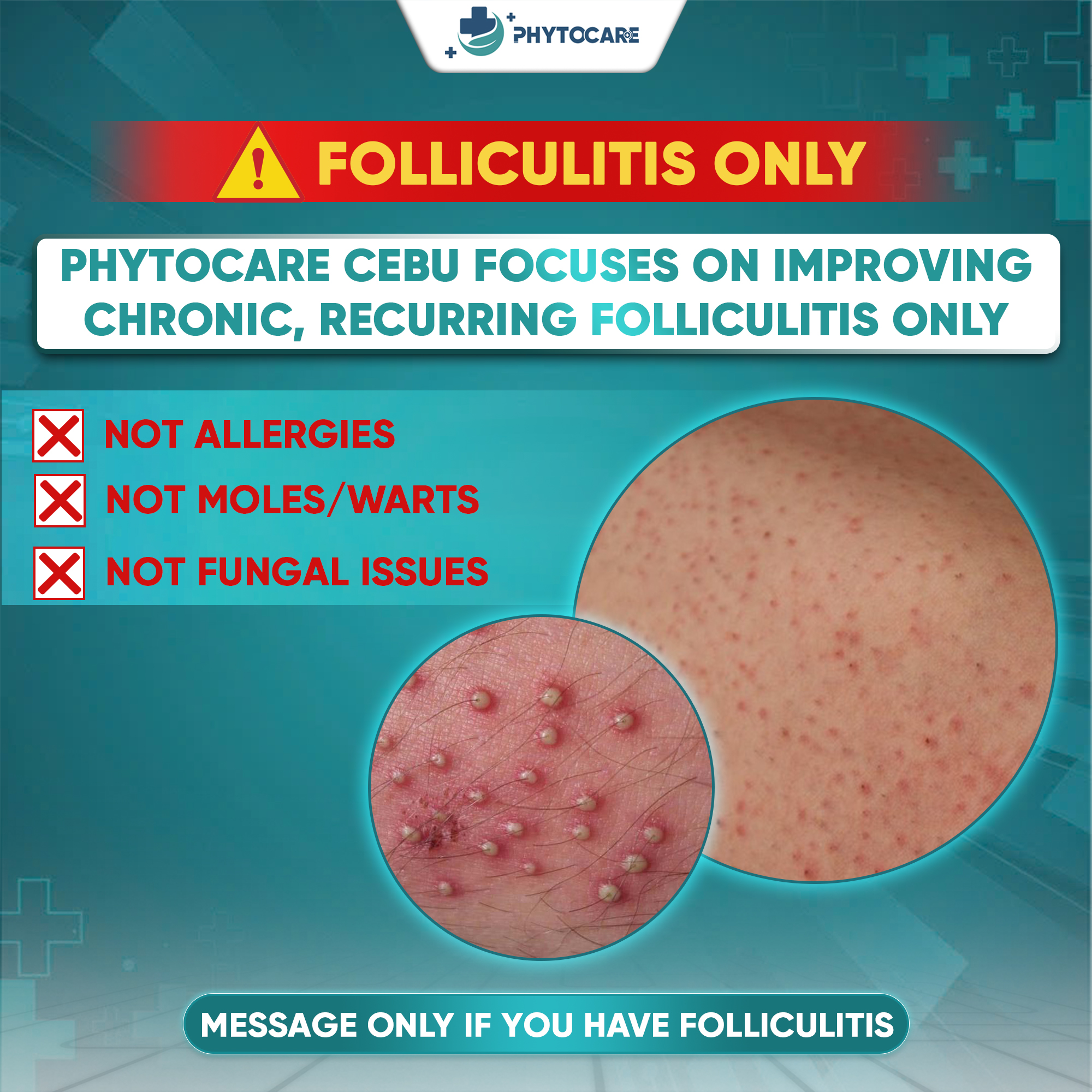 Cebu Skin & Dermatology Clinic Facebook ad: THIS POST IS FOR FOLLICULITIS ONLY