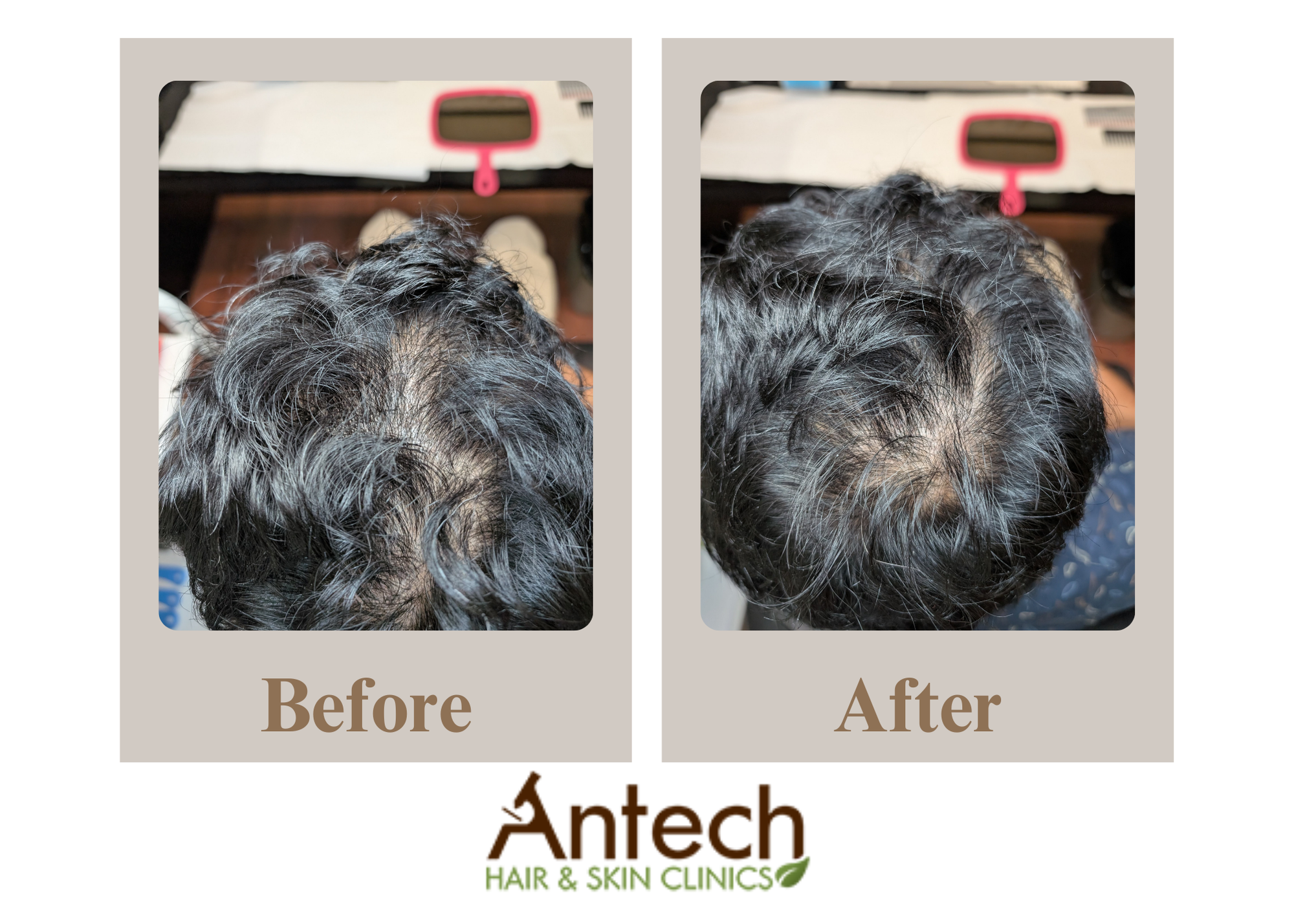 Antech Hair & Skin Clinic Facebook ad