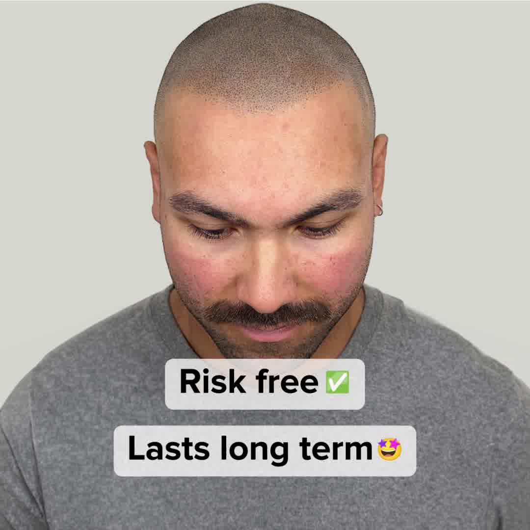SMP Ireland, Scalp Micropigmentation Ireland Facebook ad: Why Are you still Struggling Hiding your Baldness…