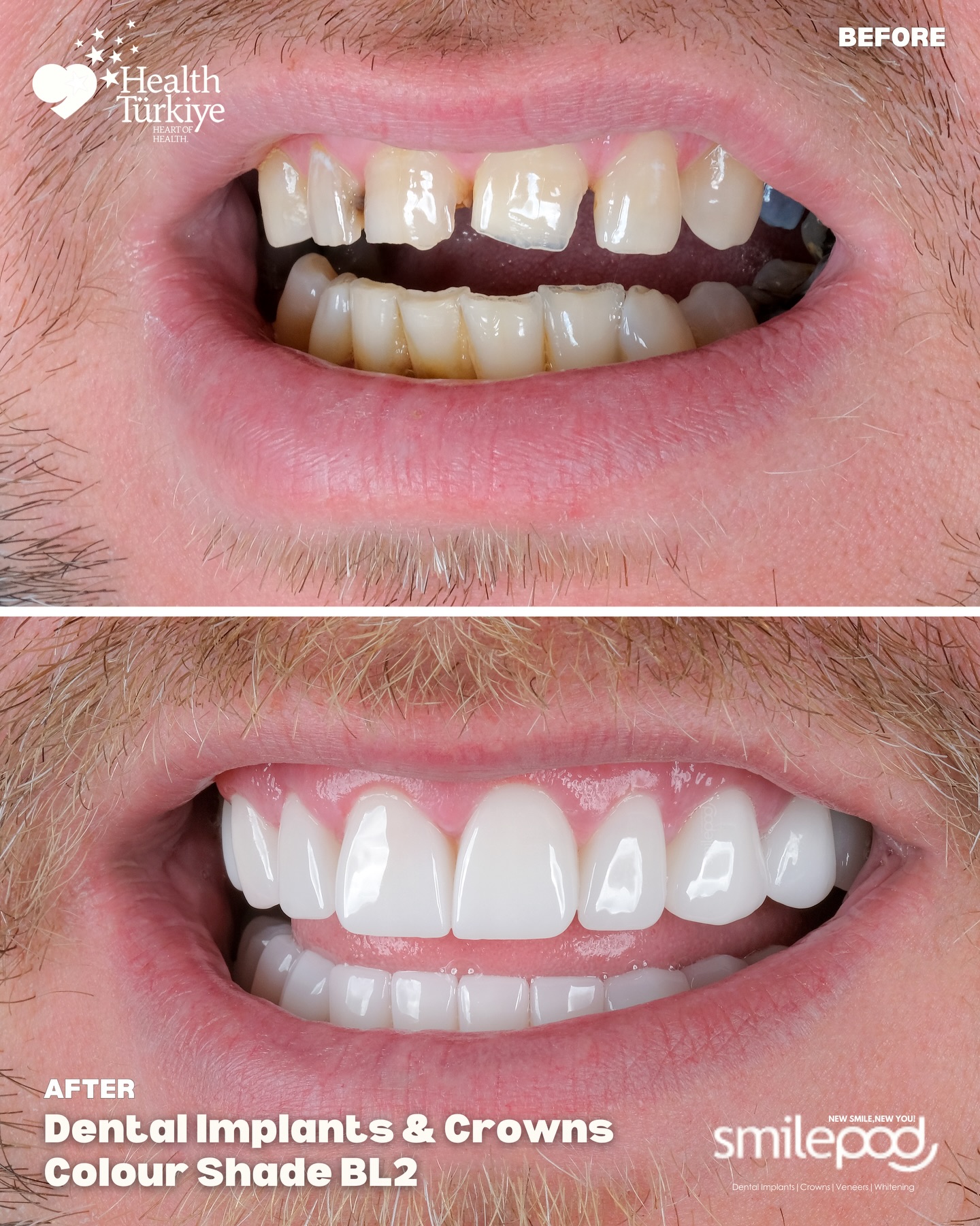 Smilepod Dental Clinic Turkey Facebook ad: Barry traveled all the way from Glasgow to…