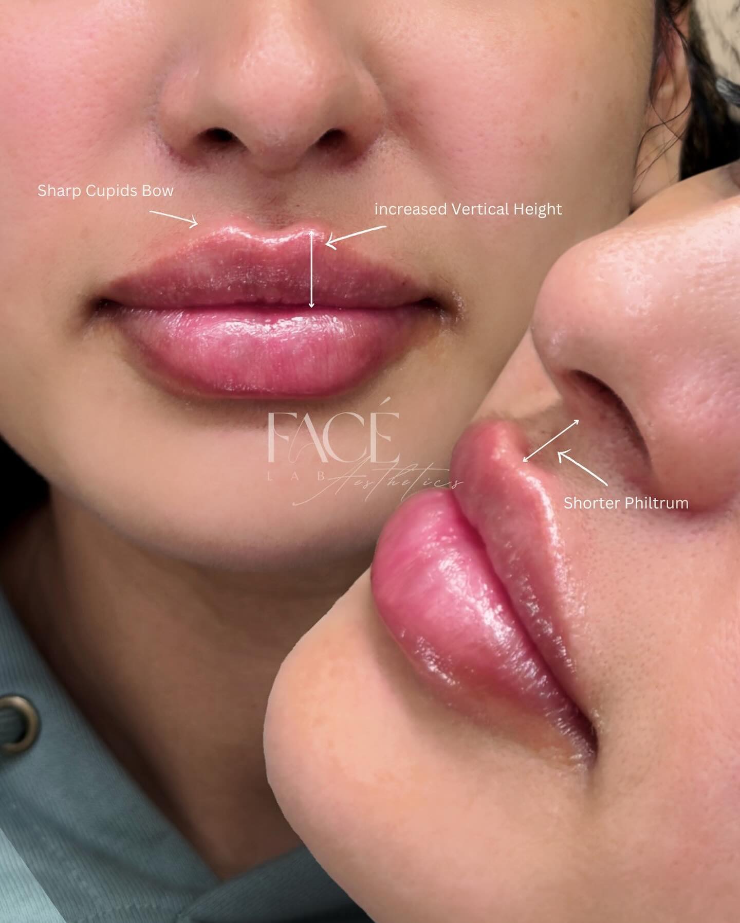 Face Lab Aesthetics Facebook ad: Bay Area Russian Lips