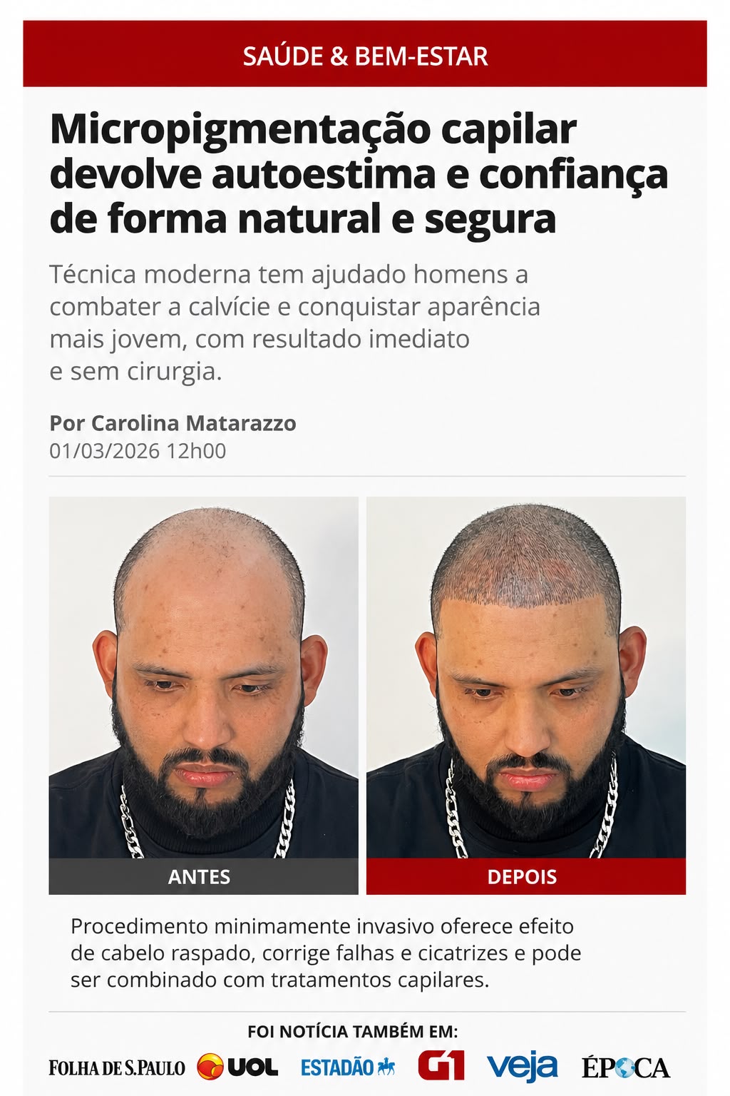 Hair line pró Facebook ad: Adeus Calvice