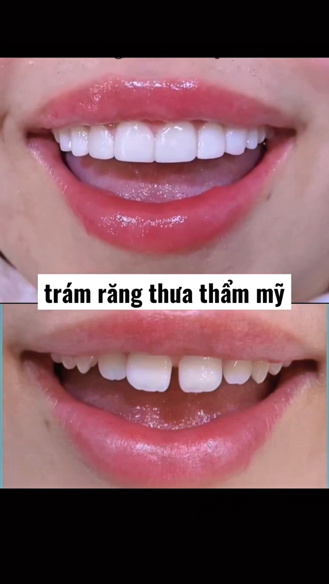 Nha Khoa WILLY - Cẩm Giàng - Hải Dương Facebook ad: 299K SMILE DESIGN CHỈ VỚI 299K/1 RĂNG