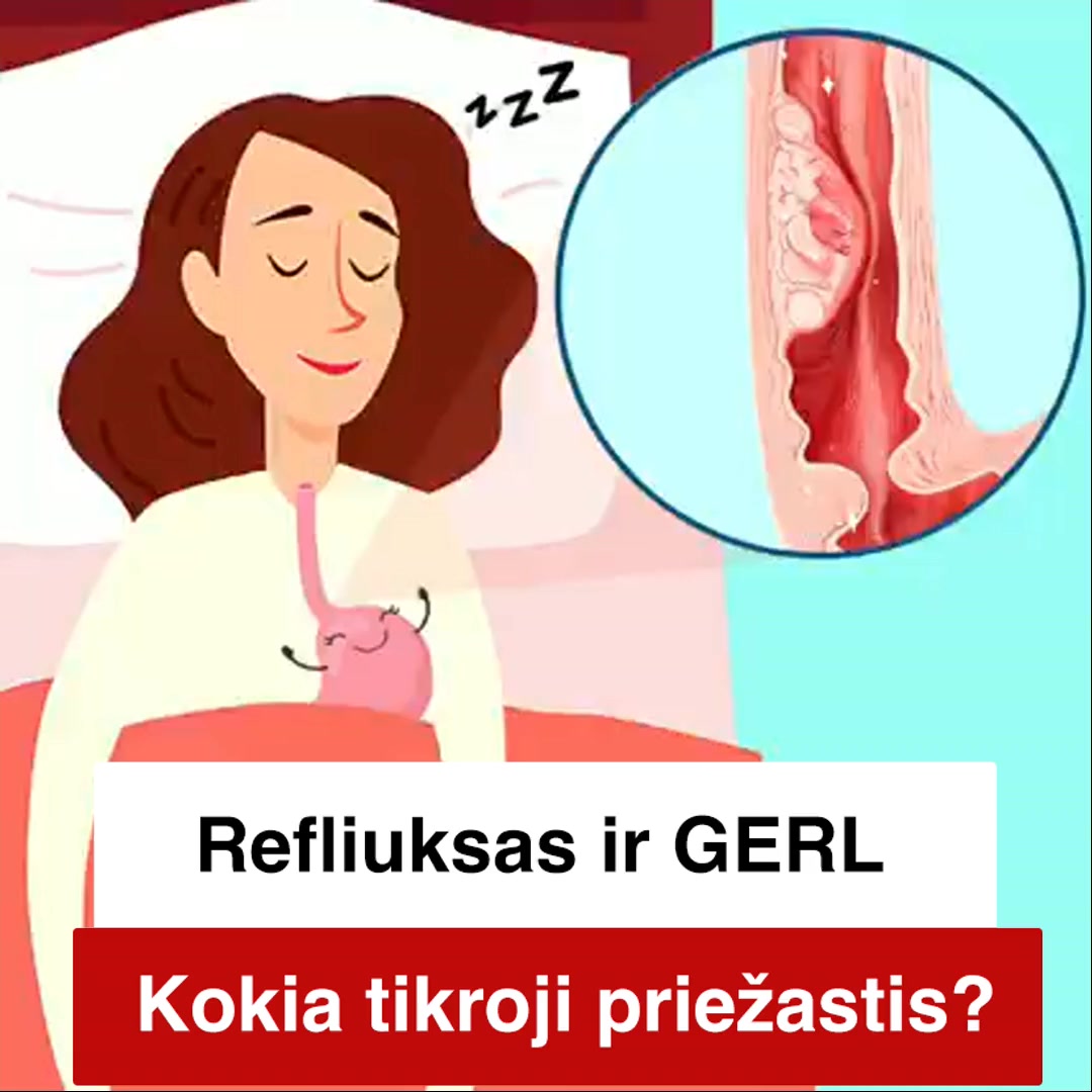 Skrandžio ABC Facebook ad: Kodėl refliuksas kartojasi?