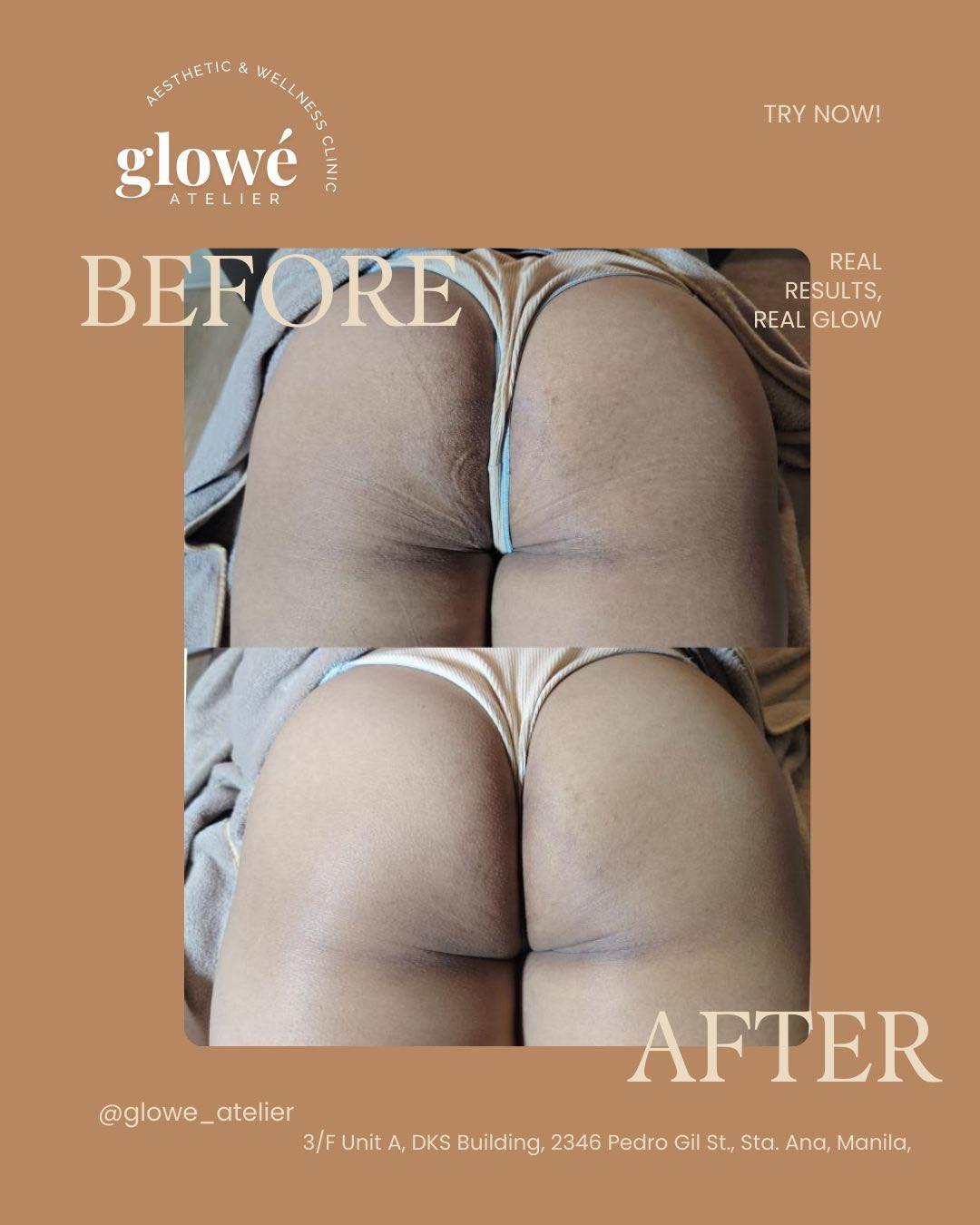 Glowé Atelier Aesthetic and Wellness Clinic Facebook ad: Give your peaches the glow they deserve!