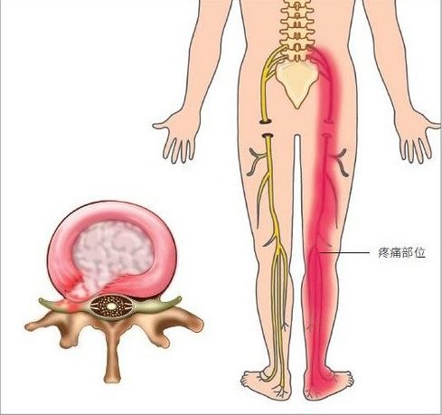 上善若水中醫痛症理療中心 Mercy Chinese Medicine Clinic 筋膜痛症 Chronic Pain Treatment Facebook ad