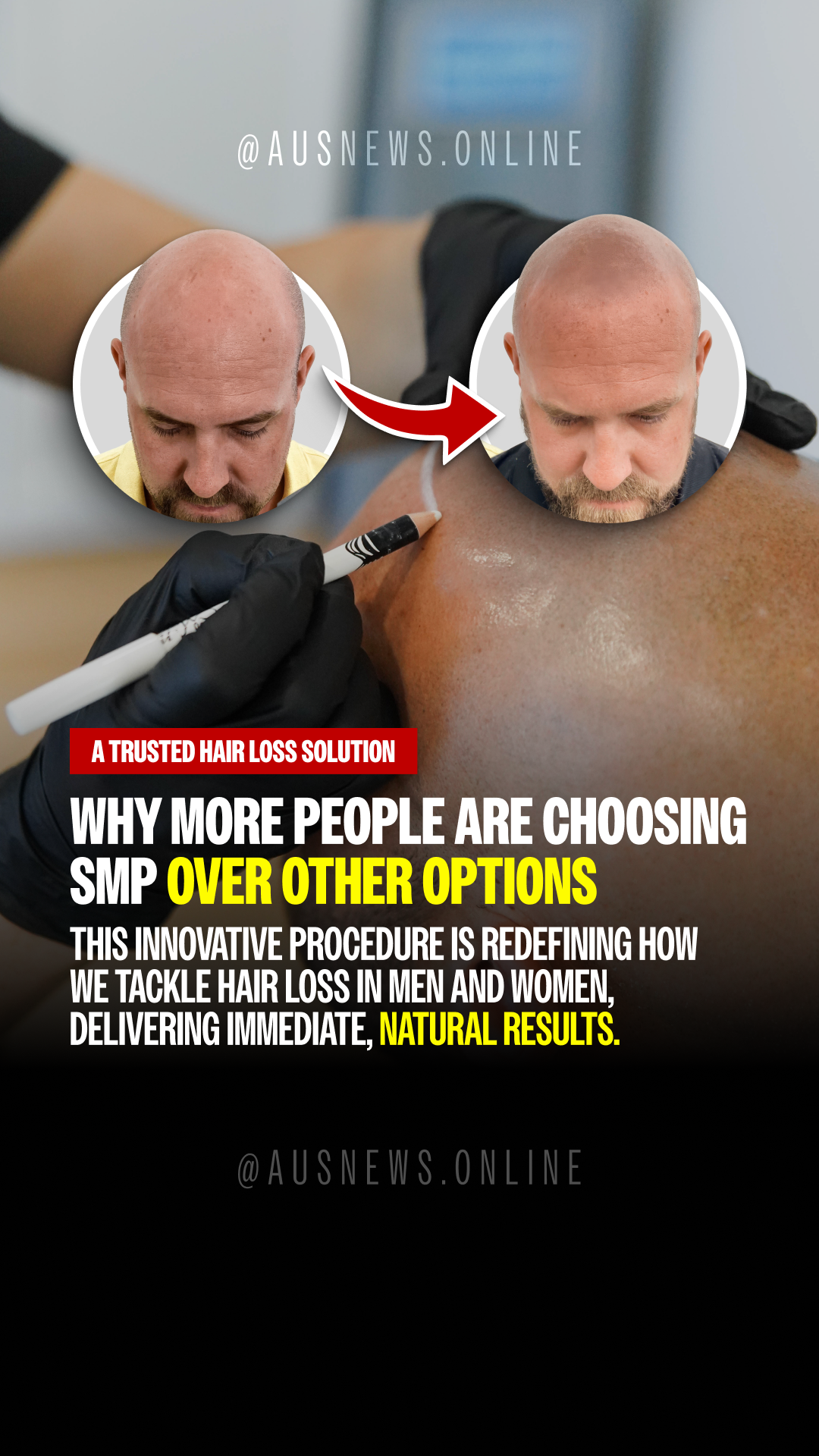 Scalp MicroPigmentation Australia Facebook ad