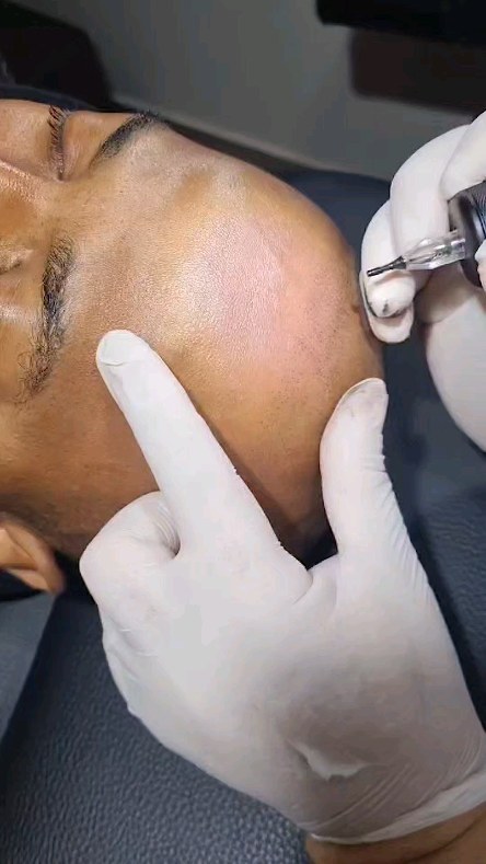 Rita Perez Micropigmentação, Tatuagem, Piercing e BioMedicina Estética. Facebook ad: Micropigmentação capilar ou tricopigmentação é um…