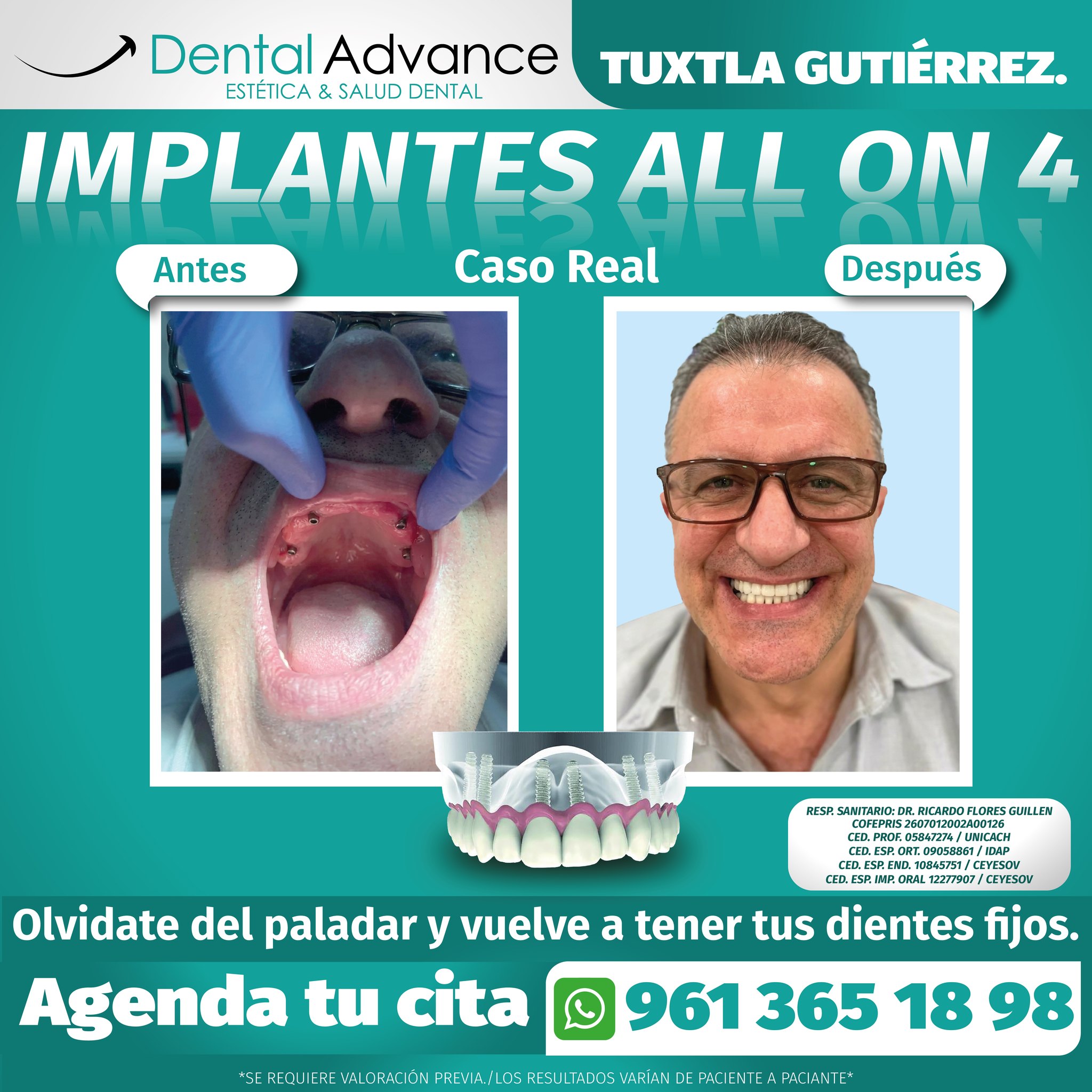 Dental Advance Estética y Salud Dental Facebook ad: ¡Dile adiós al paladar artificial y vuelve a…