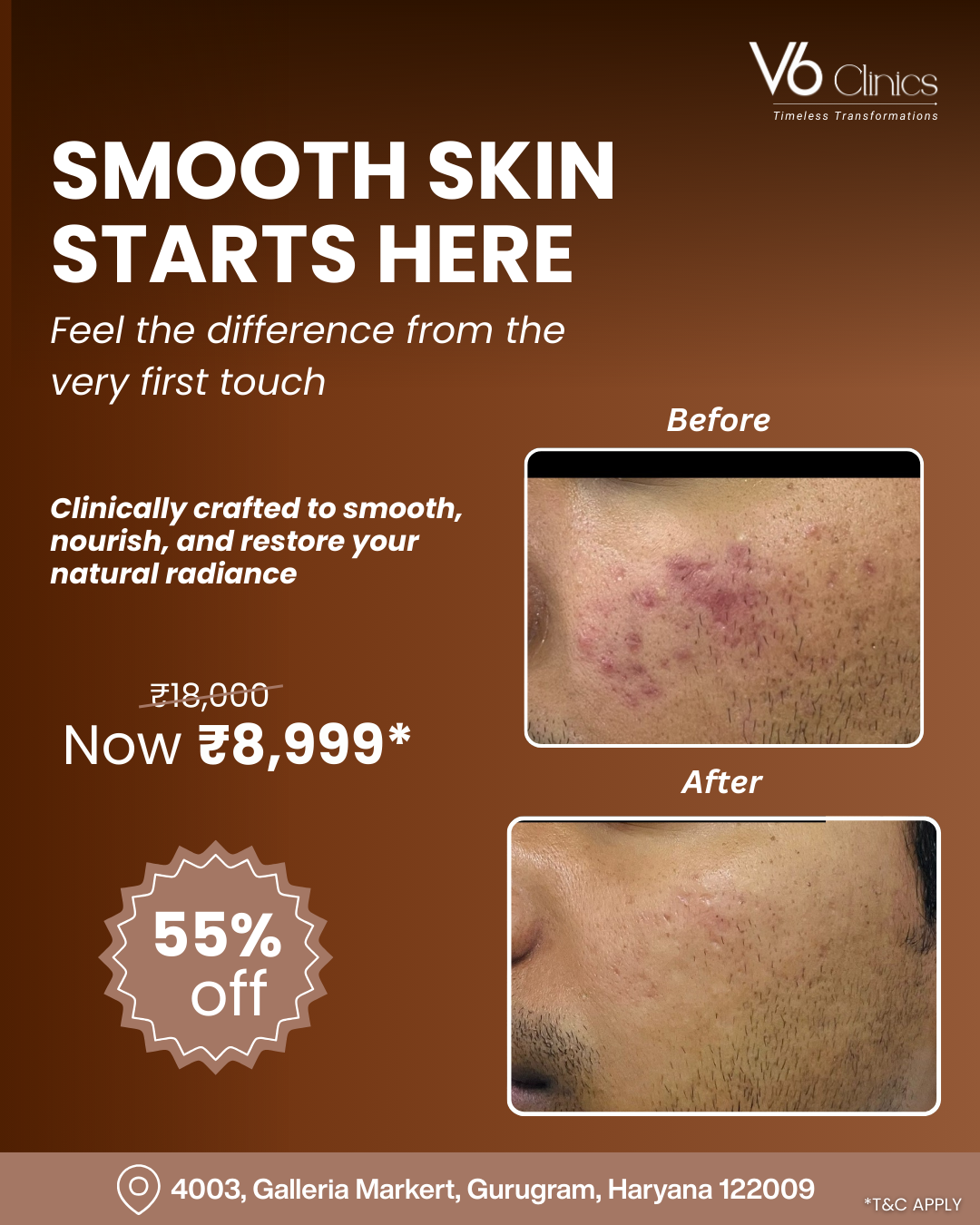 V6 Clinics Facebook ad: Say Goodbye to Acne Scars @ ₹8,999