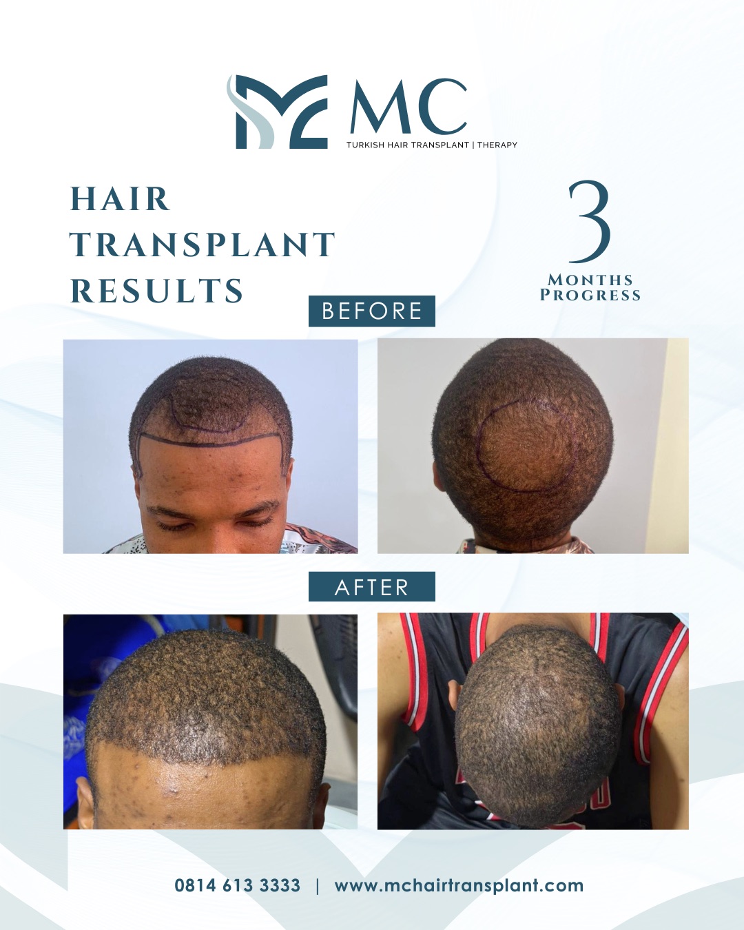 MC Hair Transplant Facebook ad: MC Turkish Hair Transplant Before ➝ After