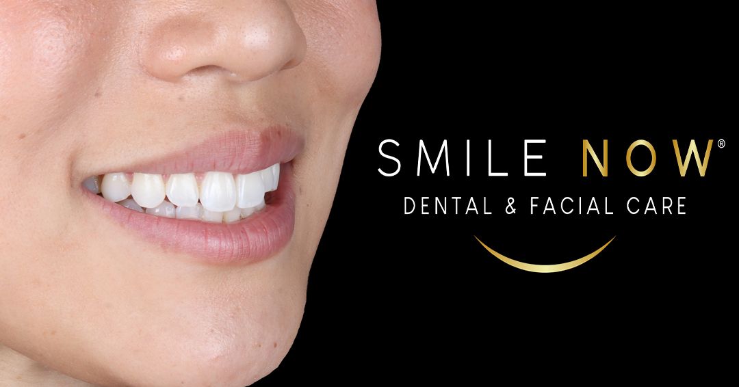 Smile Now Dental & Facial Care Facebook ad: Sonríe con Elegancia: Tratamiento de Invisalign en SMILE…