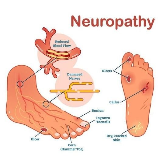 Hall Chiropractic Sports and Injury Clinic Facebook ad: FREE NEUROPATHY SOLUTION SESSION