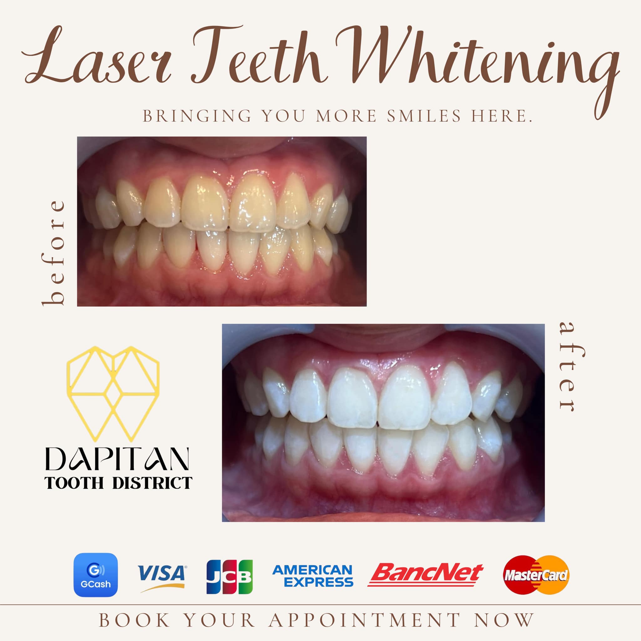 Dapitan Tooth District Facebook ad: Laser Teeth Whitening