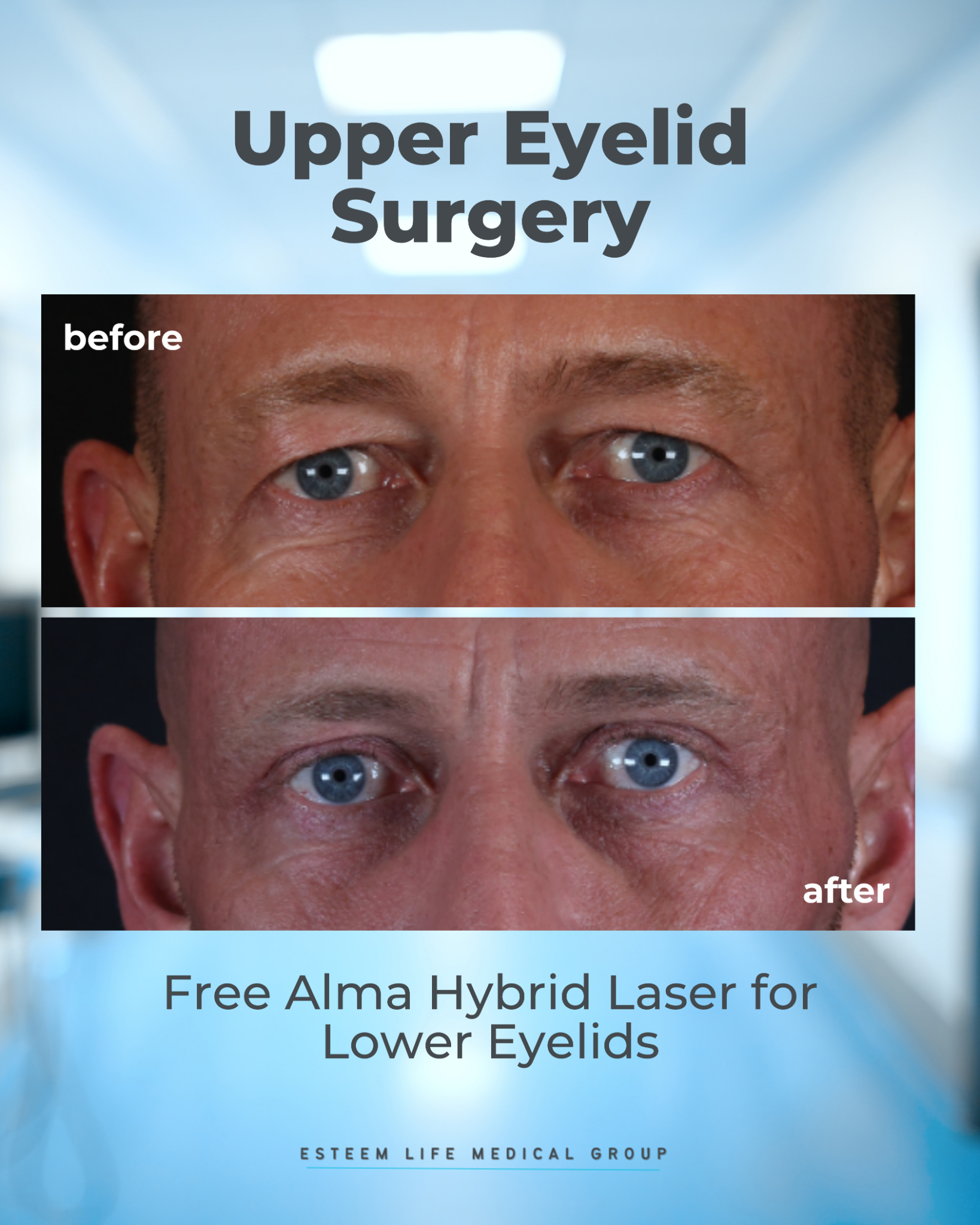 Esteem Life Medical Group Facebook ad: Upper Eyelid Surgery Consultation