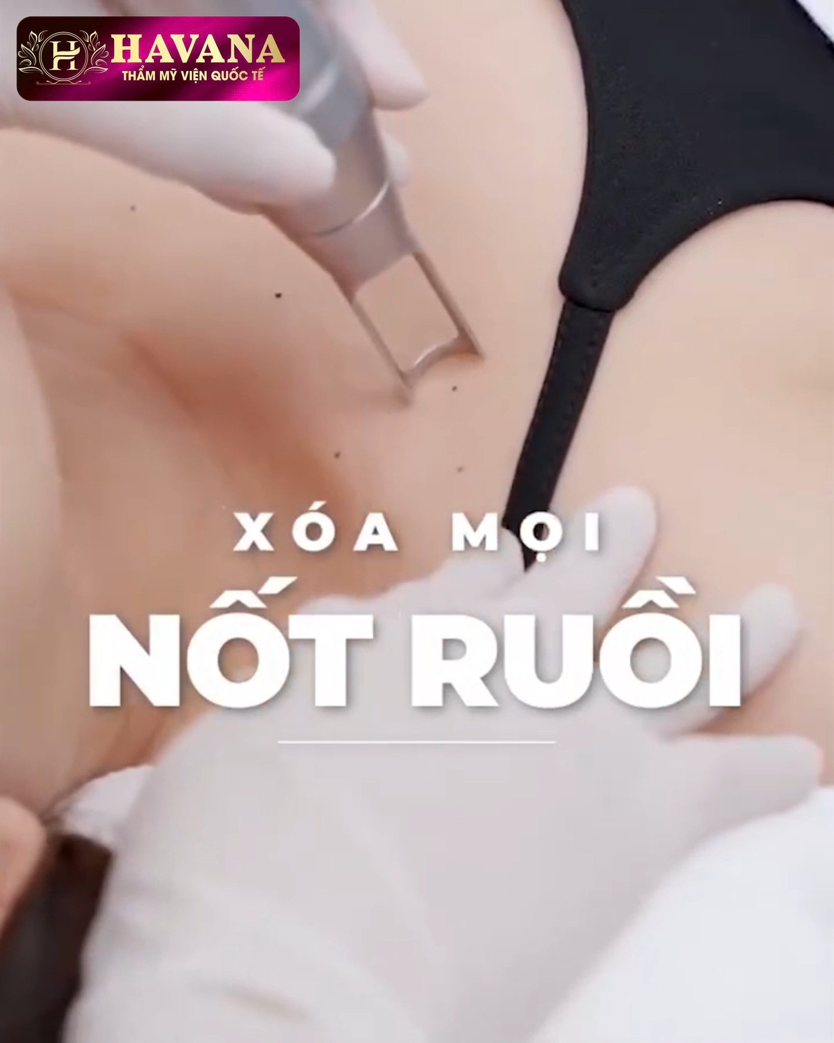 Viện Da Liễu Công Nghệ Cao Số 1 Hải Phòng Facebook ad: Xóa nốt ruồi - Tự tin hơn - Đón nhiều tài lộc hơn